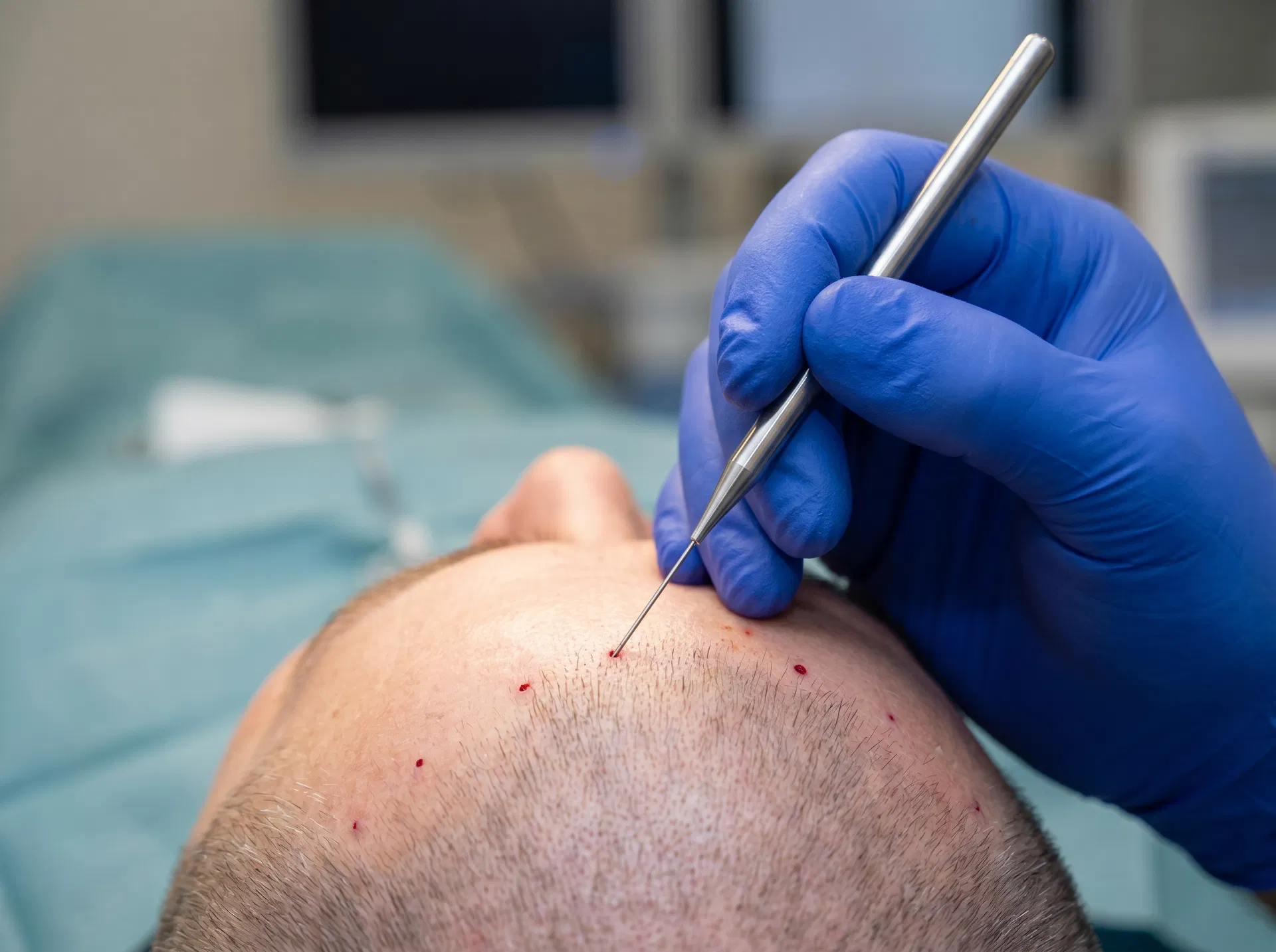 Perkutan FUE hair transplant technique offered at Istanbul Hair Center Turkey