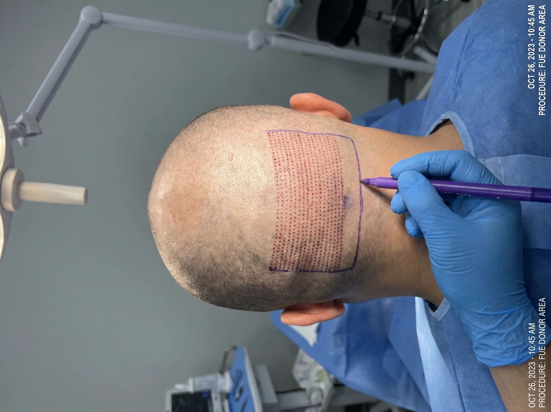 Sequential Technique (FUE) hair transplant technique offered at ASMED Surgical Medical Center Turkey