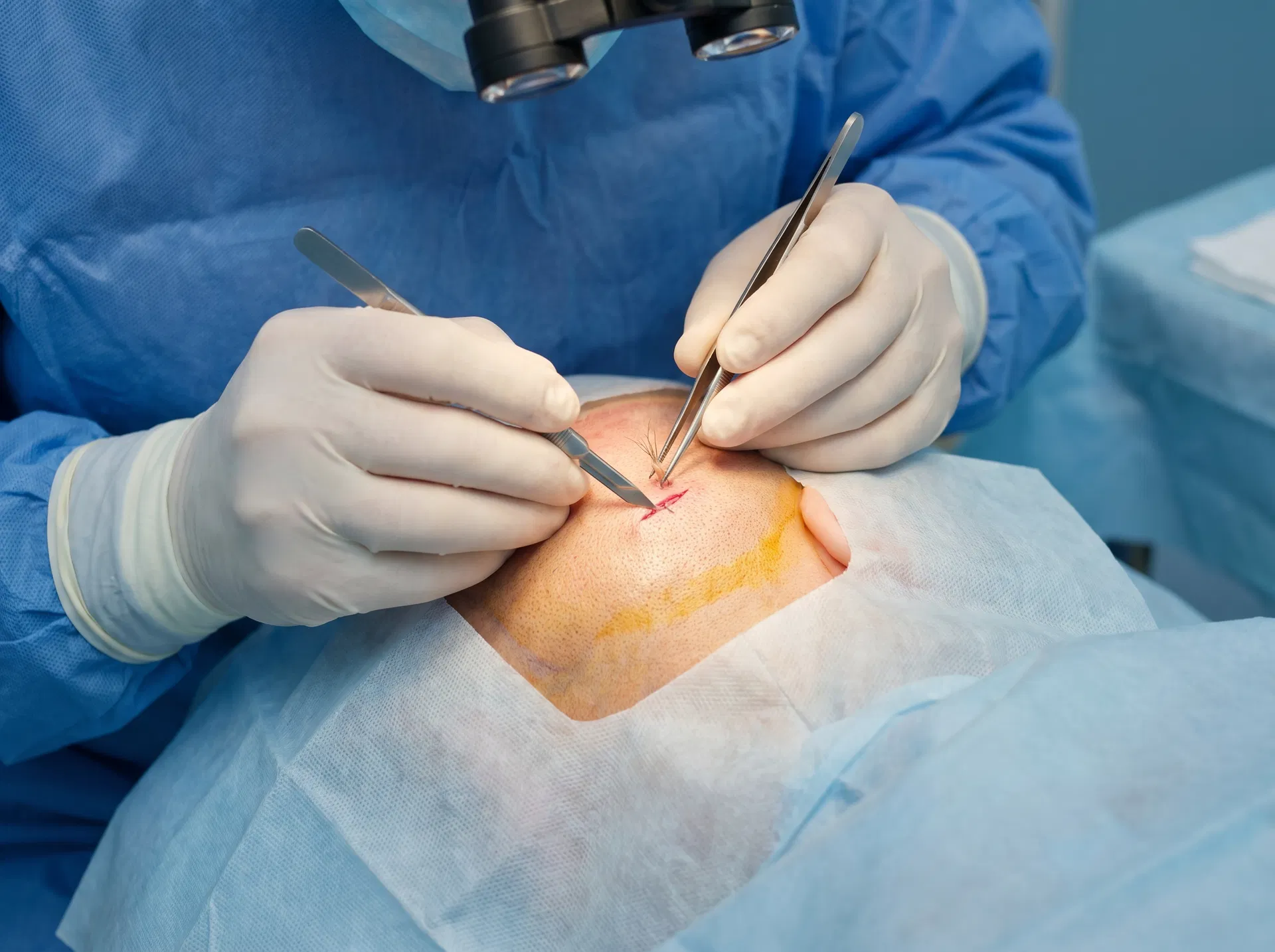 Stick-and-Place hair transplant technique offered at Dr. Pekiner Clinic Turkey