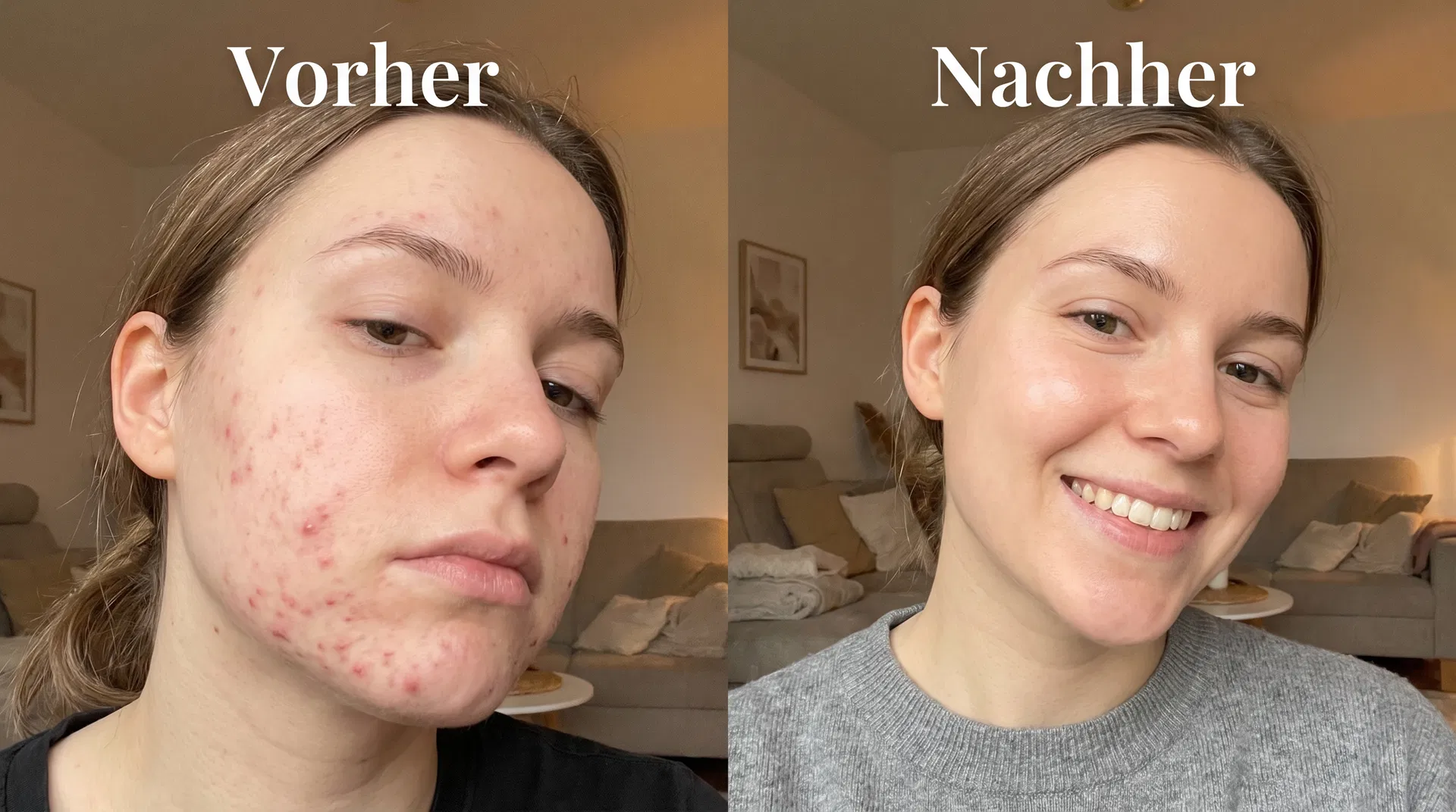 Vorher Nachher Lara, 22