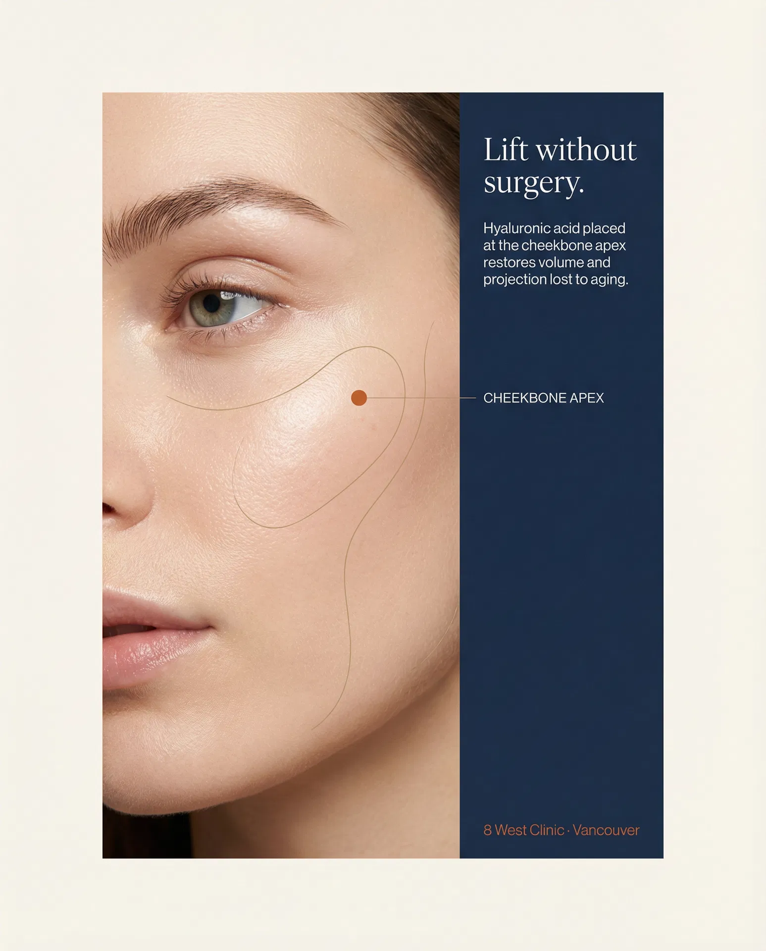 Cheekbone augmentation — the Elevation Mark applied to a non-surgical lift post.
