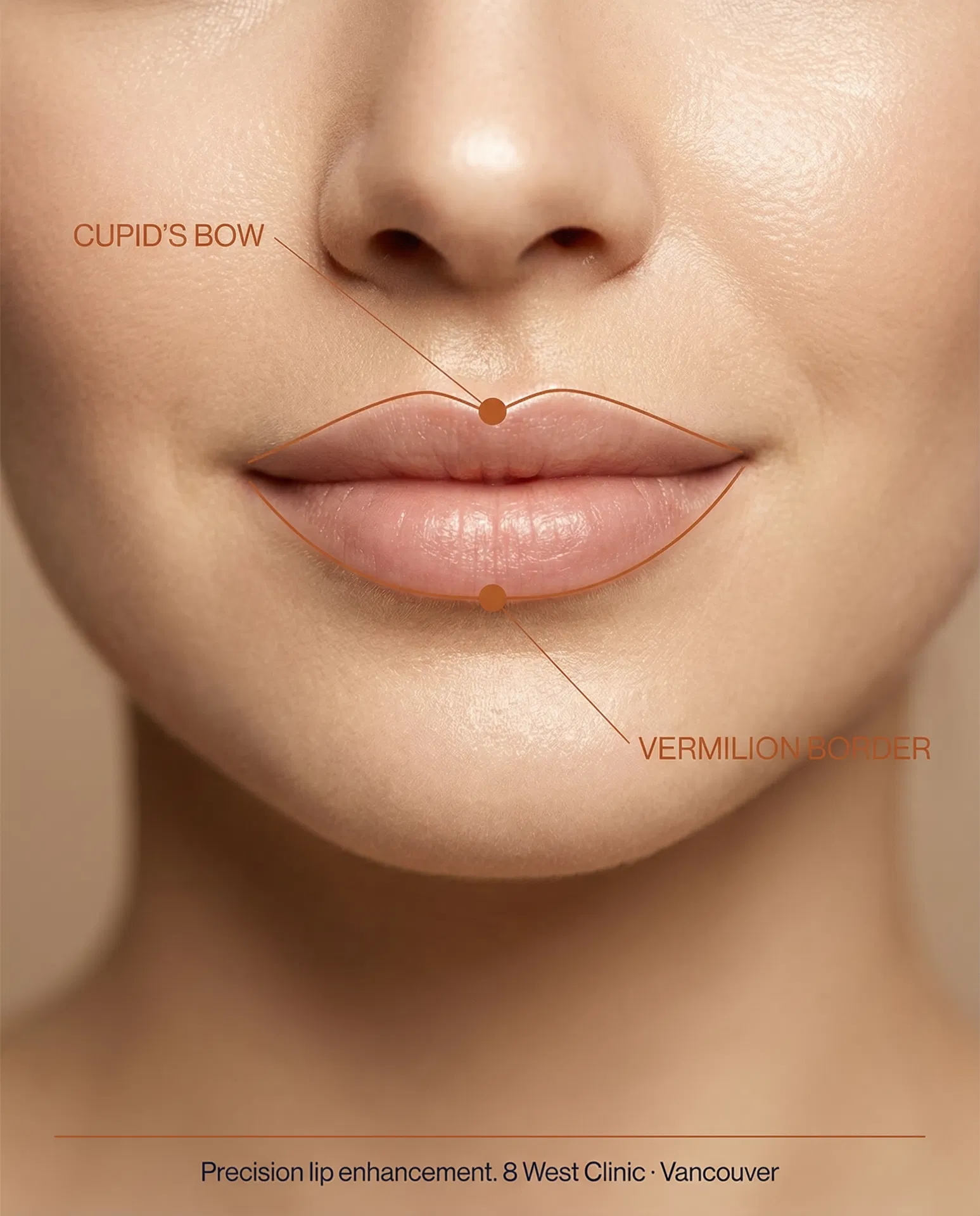 Lip enhancement — vermilion border annotation applied to a precision lip post.