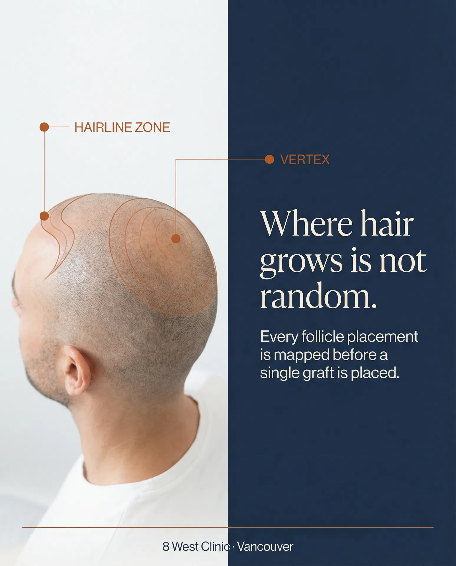 Hair restoration Elevation Mark — hairline zone and vertex mapping
