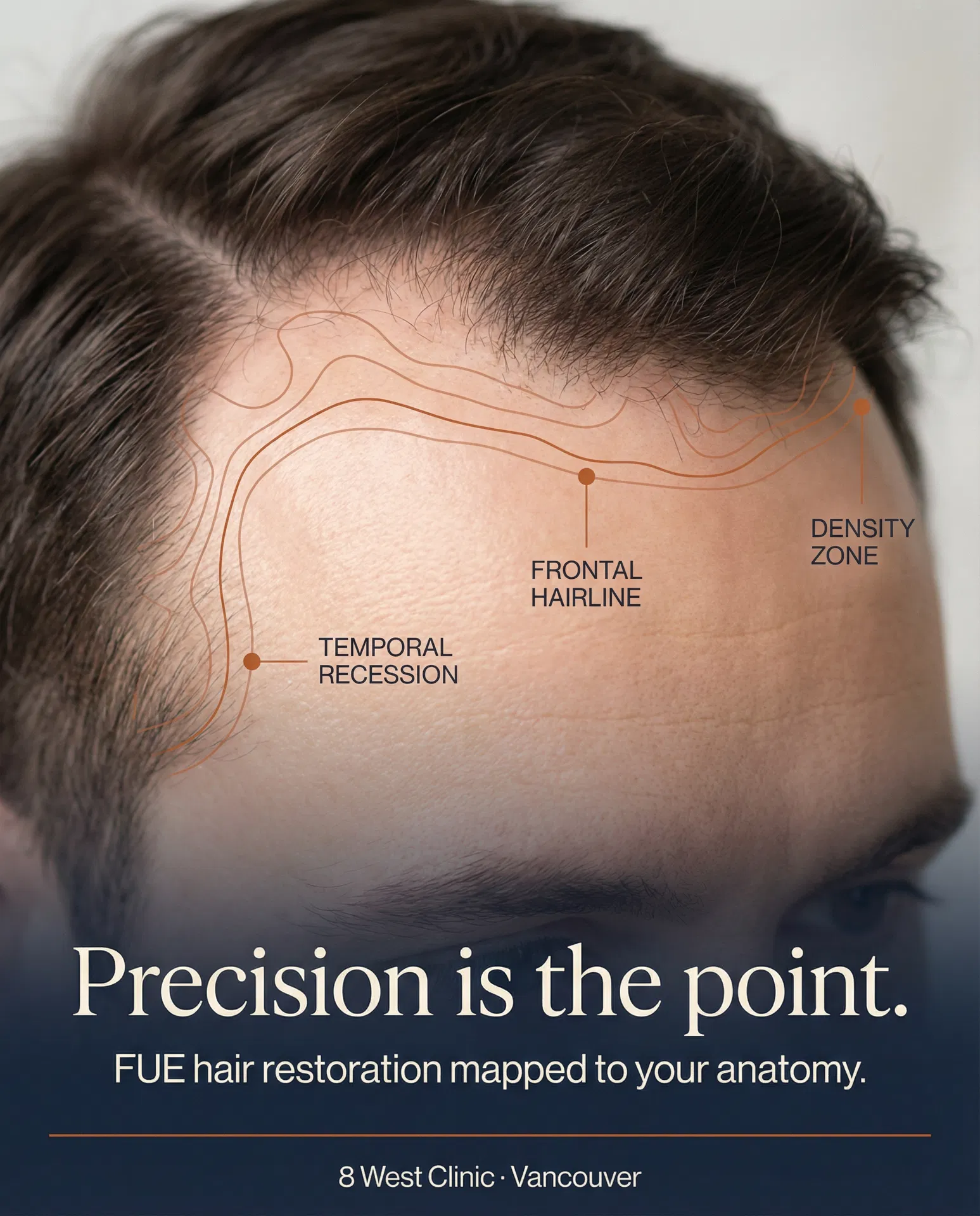 Precision is the point — FUE hairline mapping