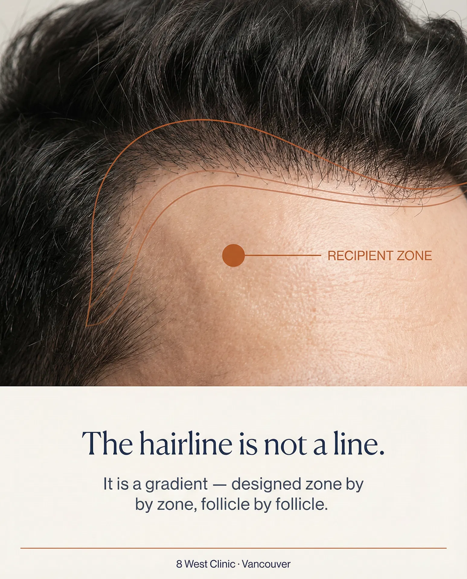The hairline is not a line