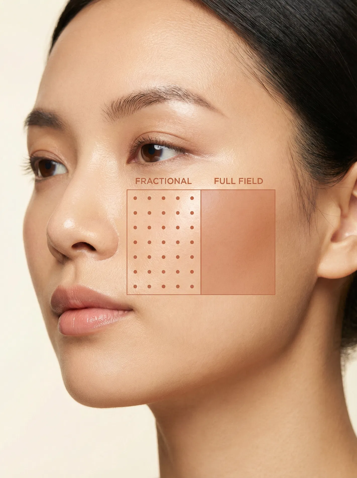 Fractional vs Full-Field Laser — Elevation Mark annotation