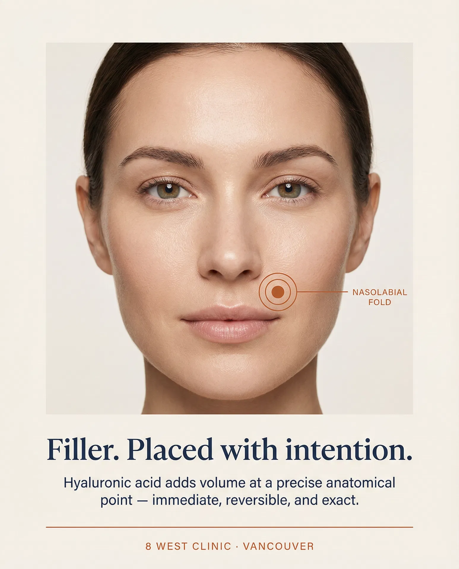 Post 02 — Filler Precision