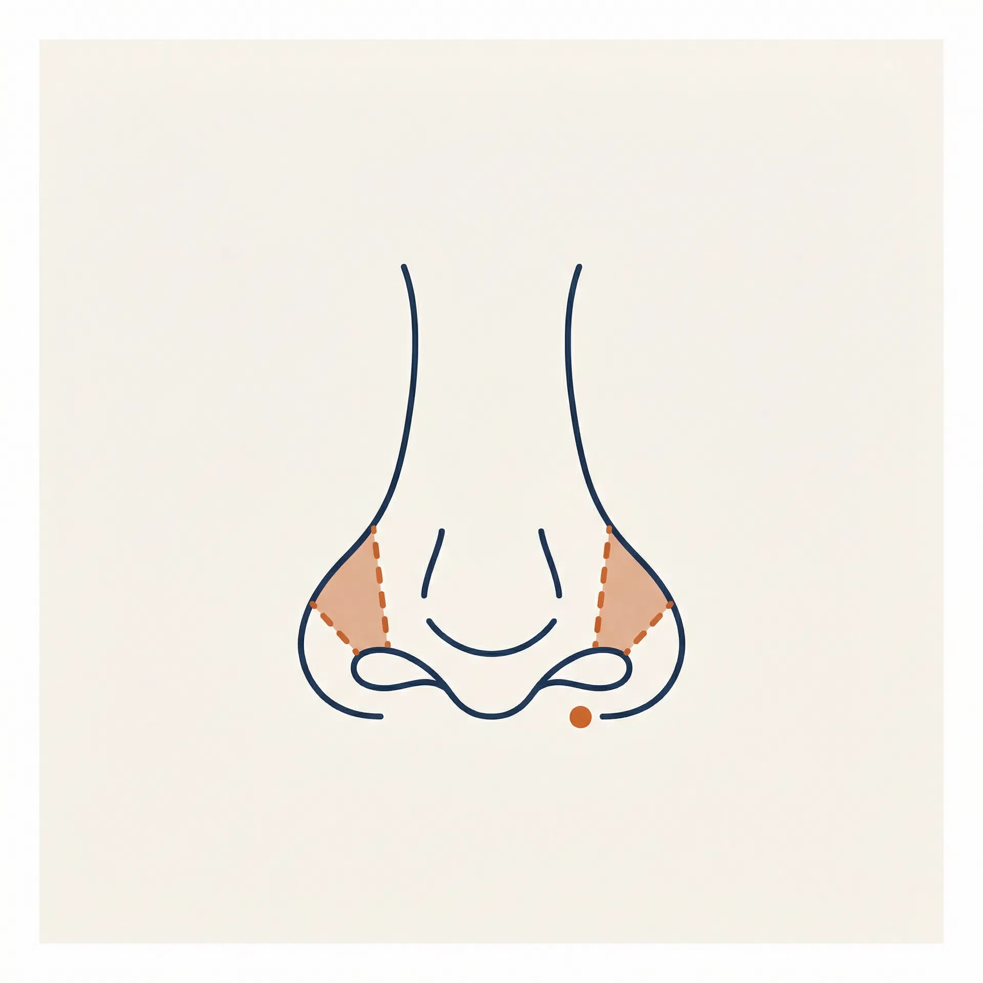 Alar Base Reduction surgical diagram