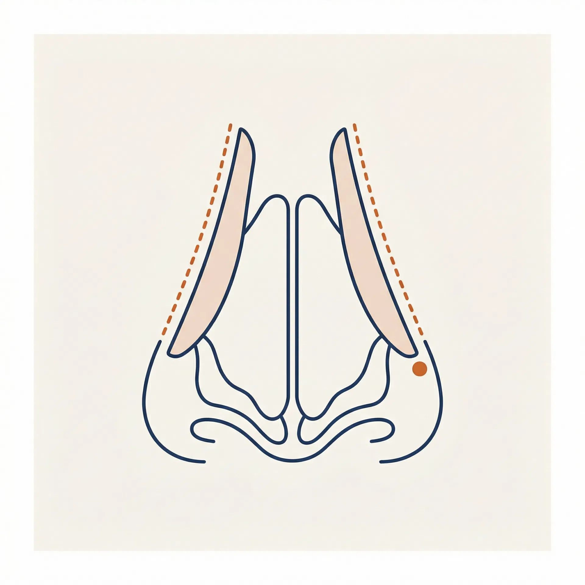Cephalic Trim surgical diagram