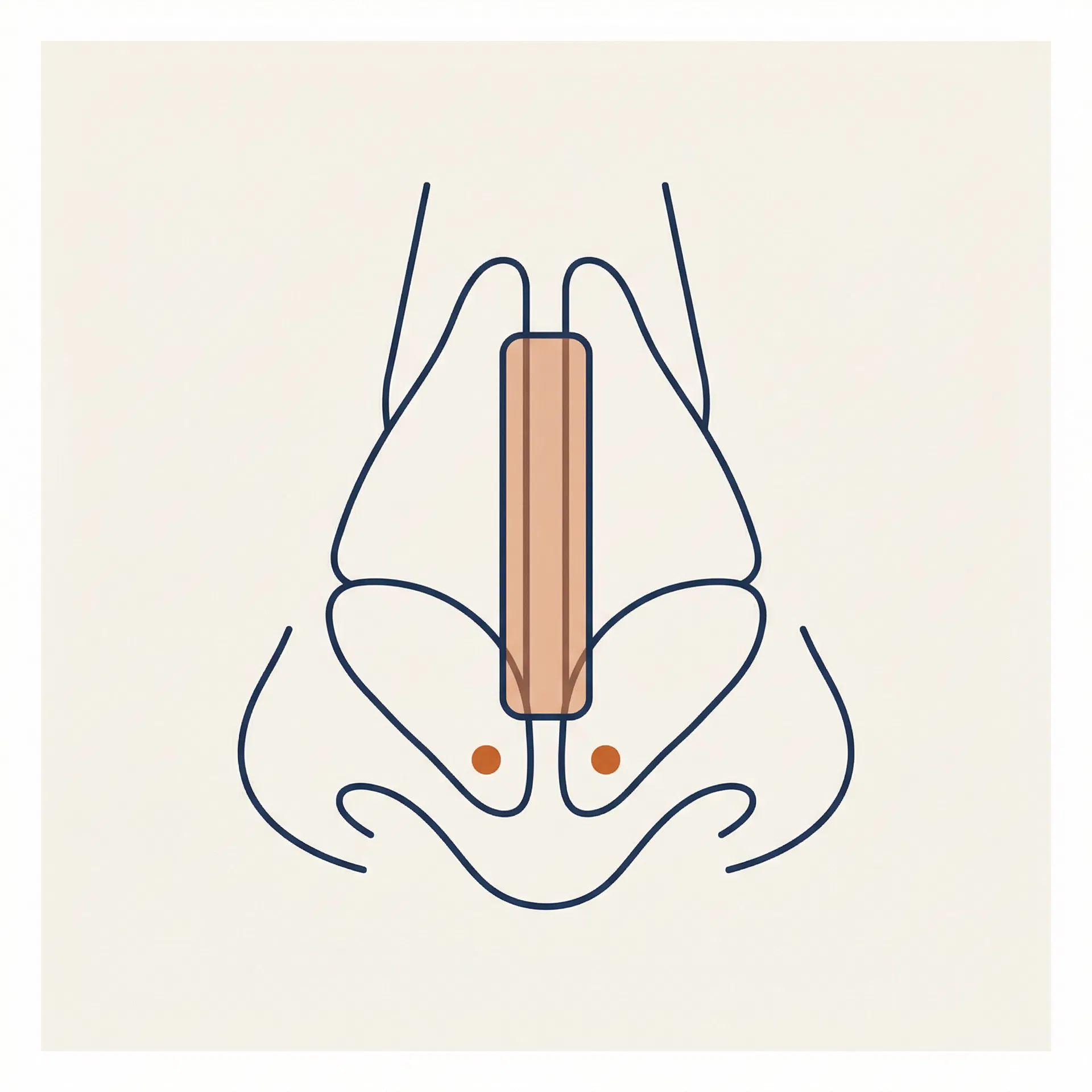 Columellar Strut Graft surgical diagram