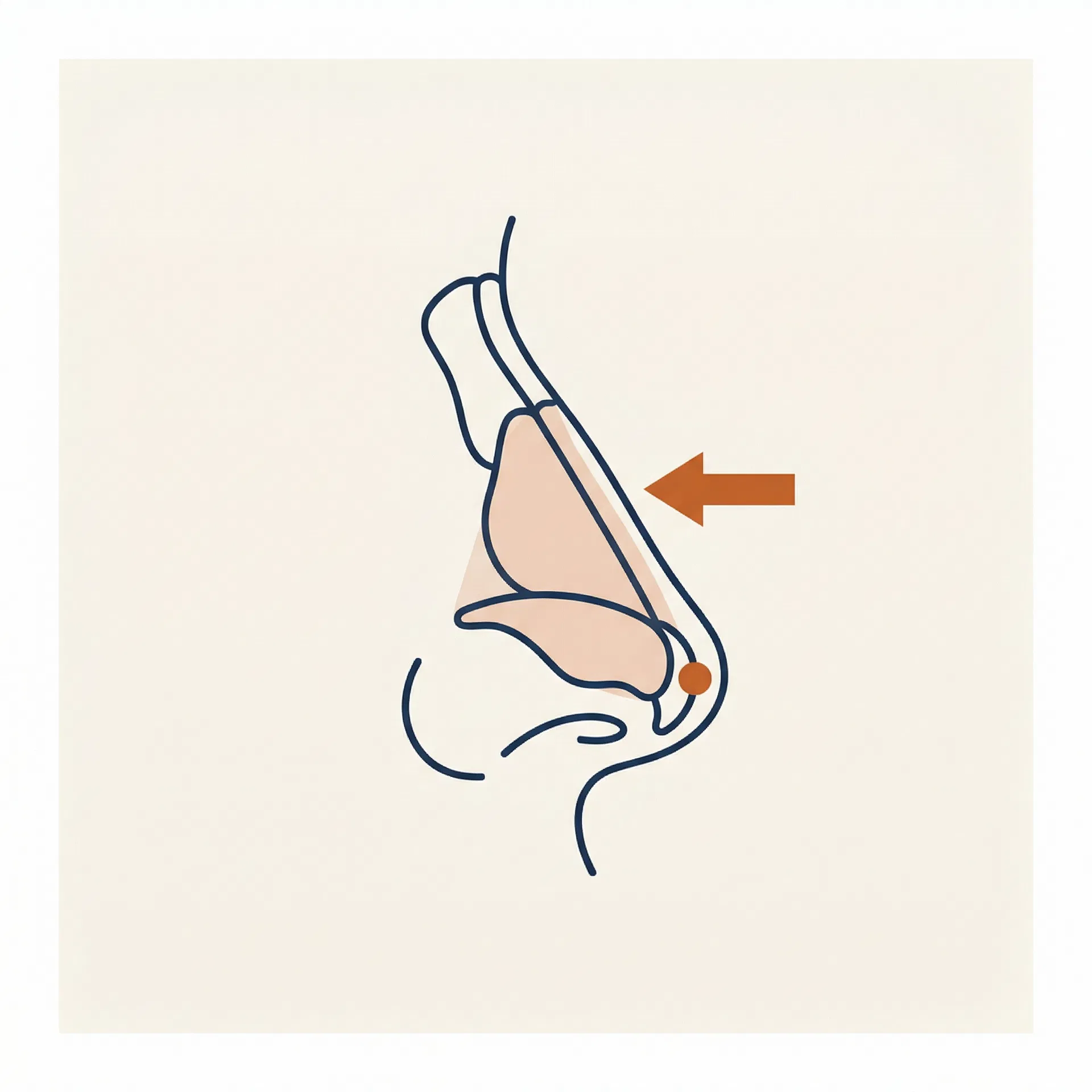 Deprojection surgical diagram