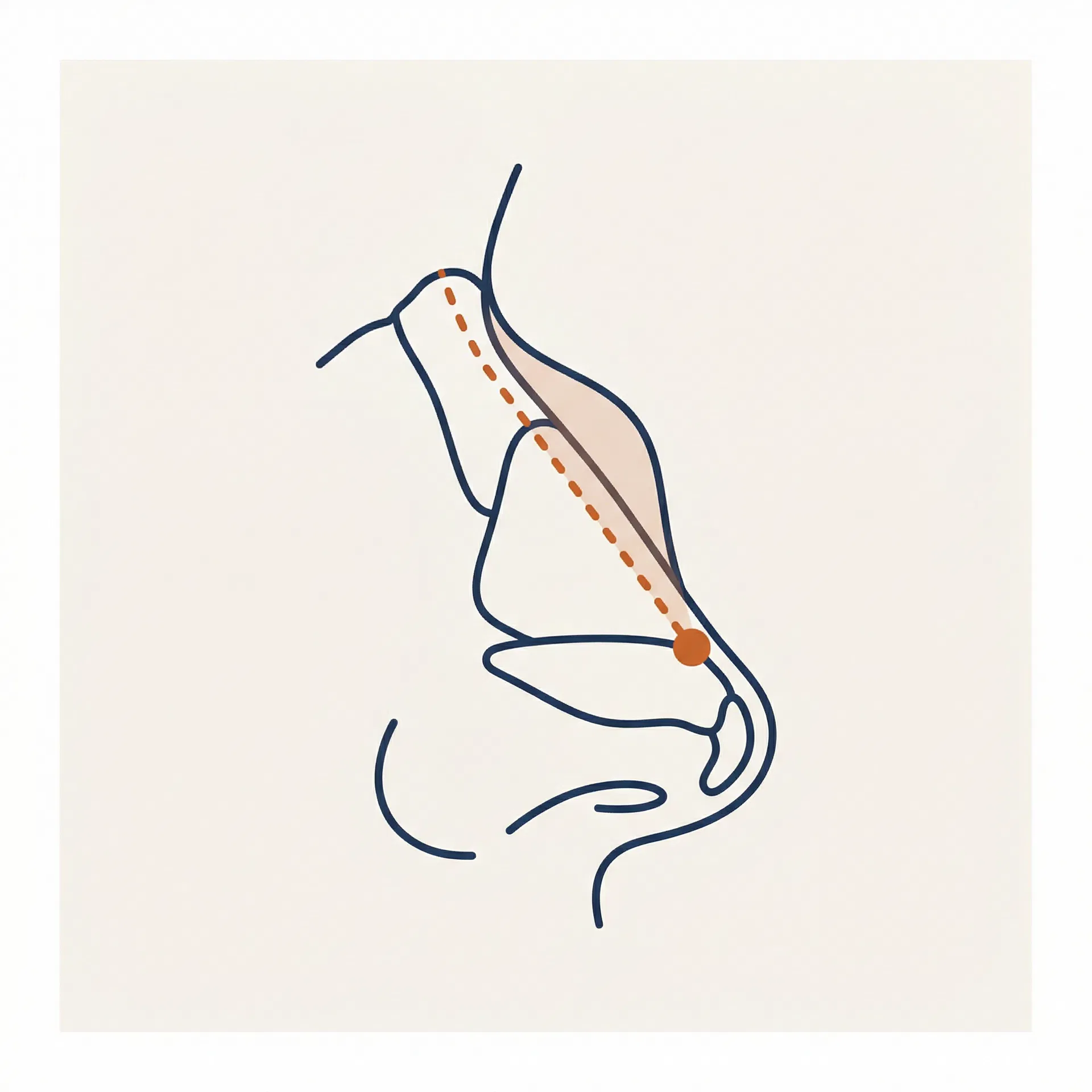 Dorsal Hump Reduction surgical diagram