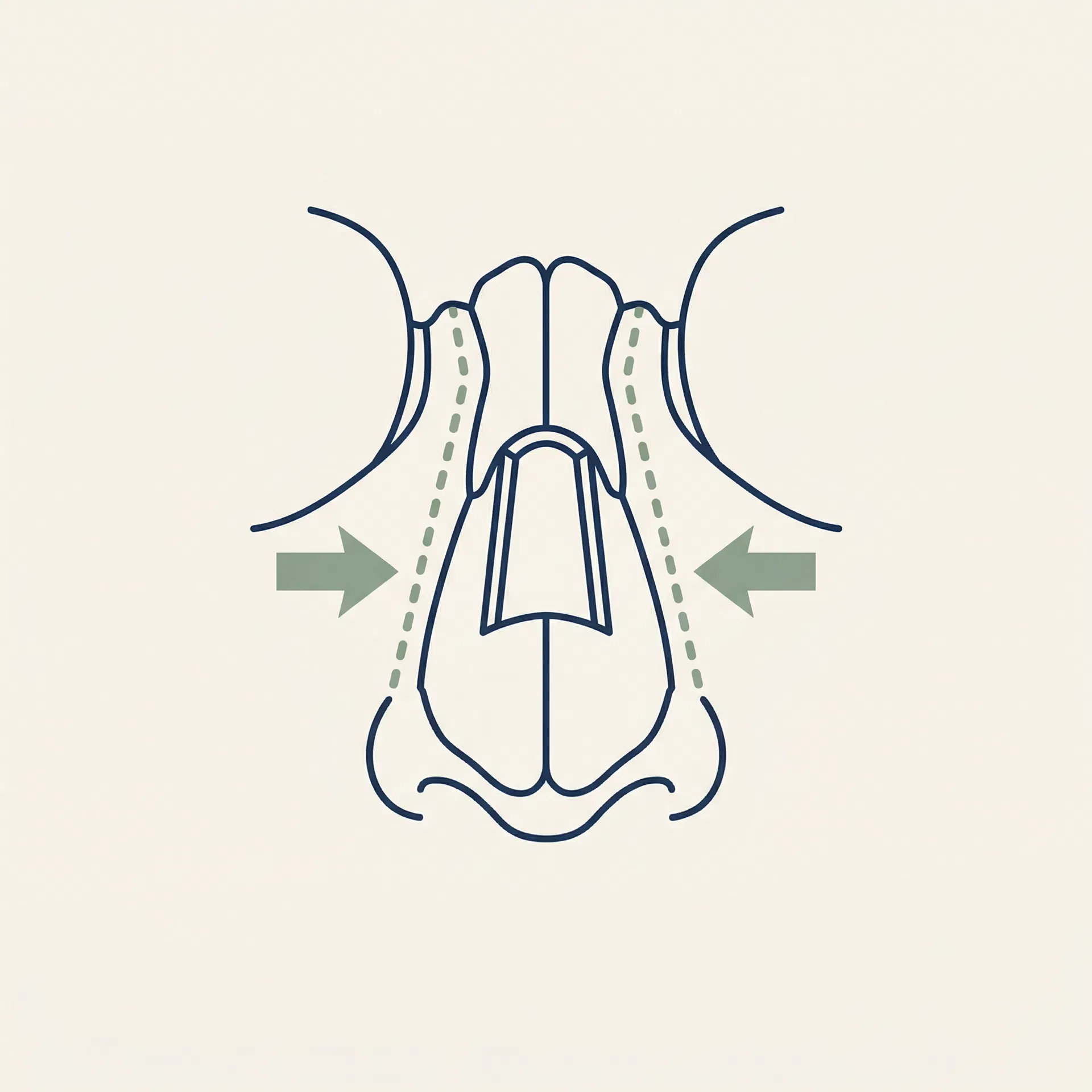 Osteotomy illustration