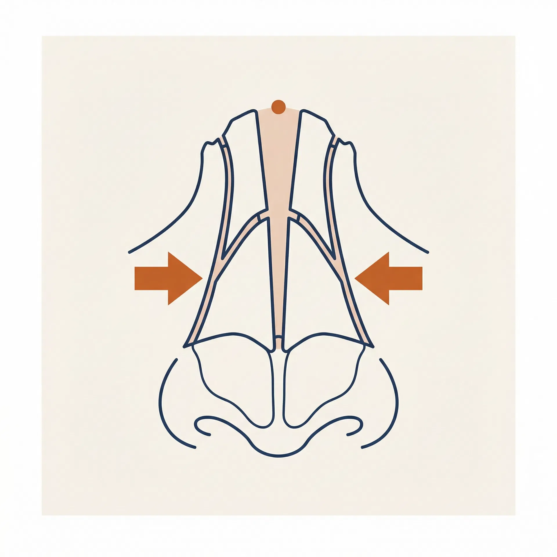 Osteotomy surgical diagram