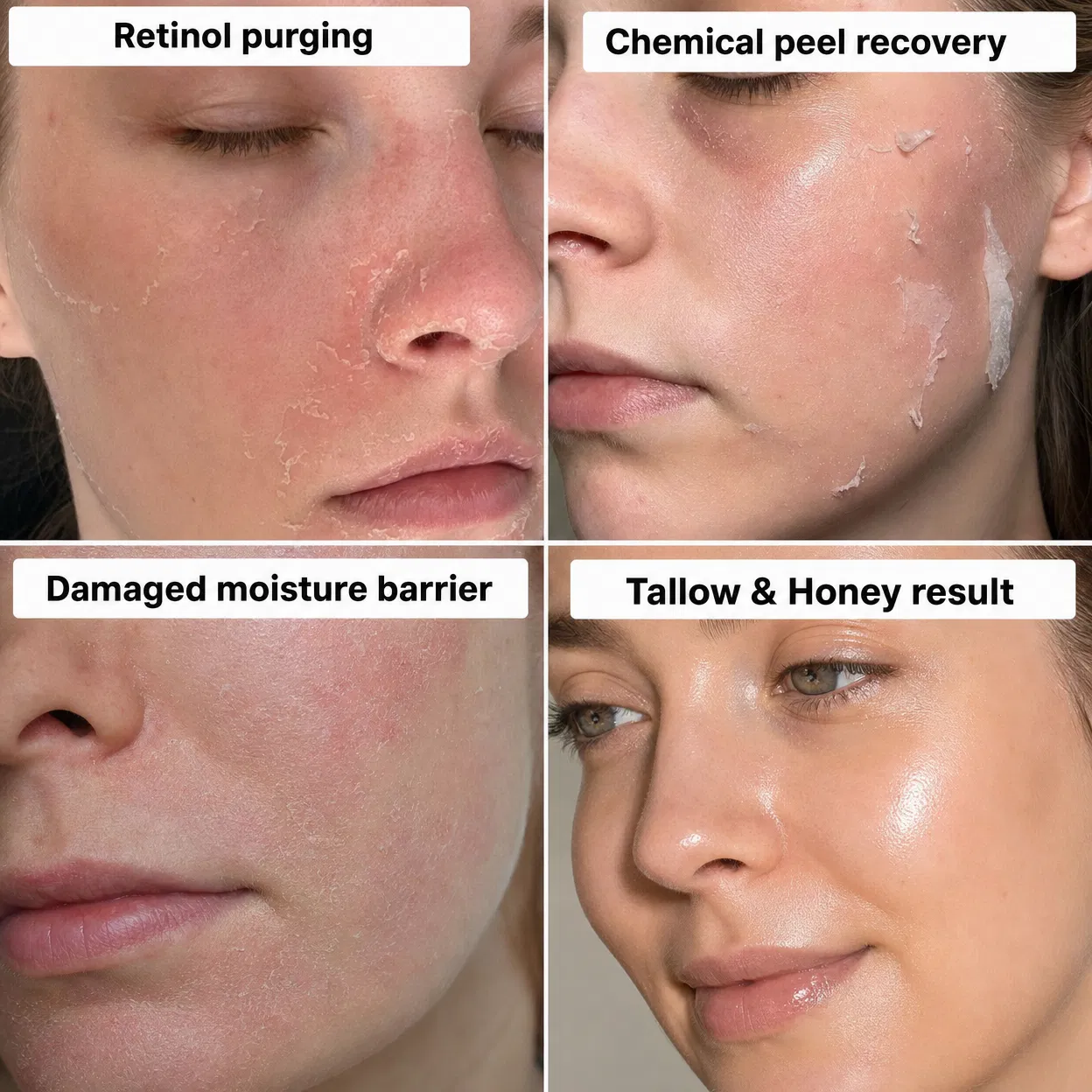 Skin damage from retinol, chemical peels, and damaged moisture barrier vs Tallow & Honey result
