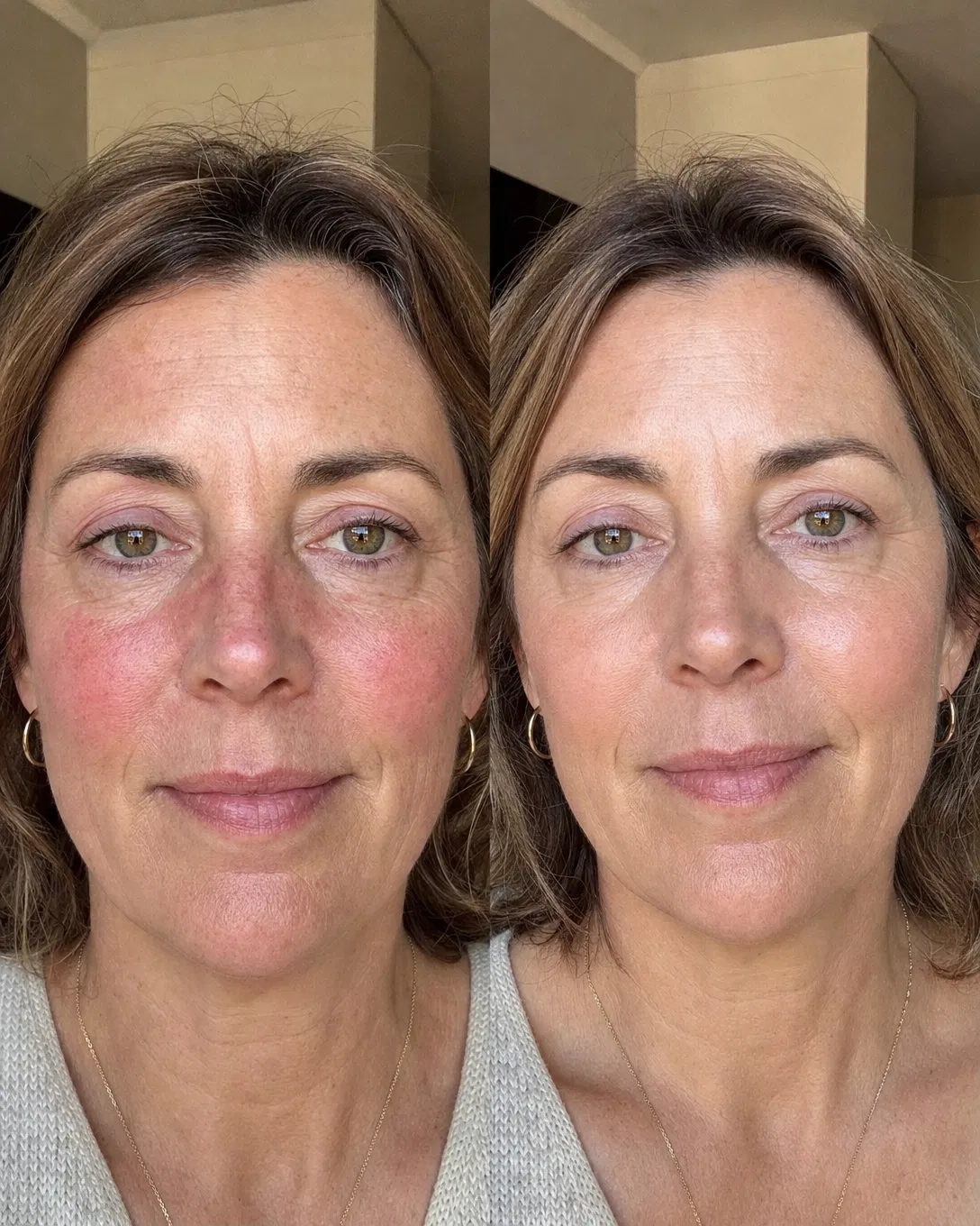 Real before and after skin transformation with Lux Skin Microbiome Restore