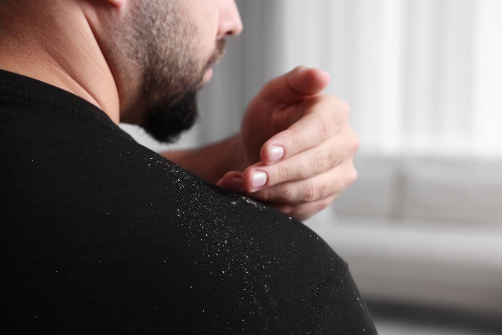 Șampon antimătreață: Descoperă secretul ingredientelor active și cum te scapă de problemă!