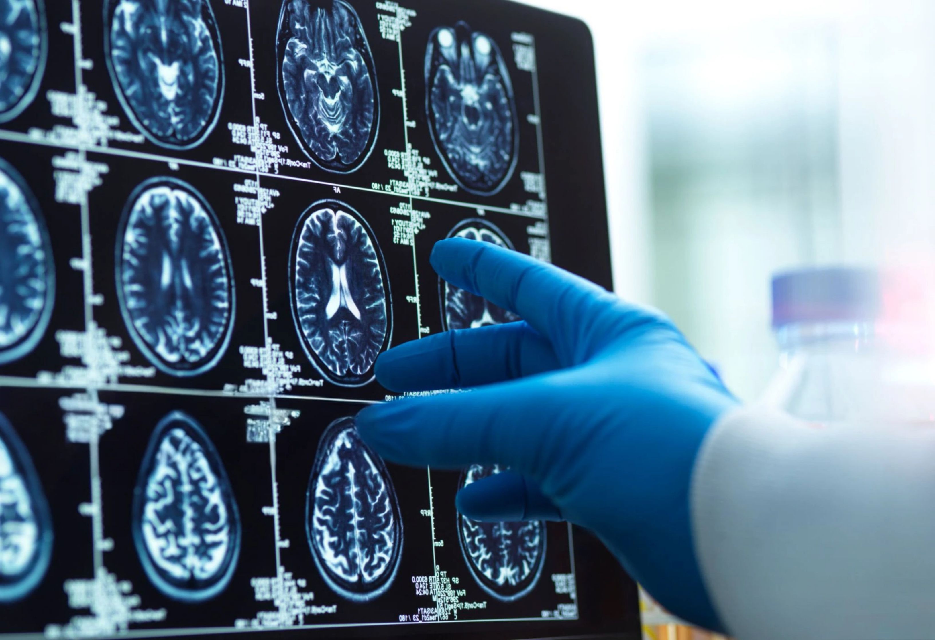 Harta îmbătrânirii creierului: Misterul zonelor vulnerabile la Alzheimer, dezvăluit