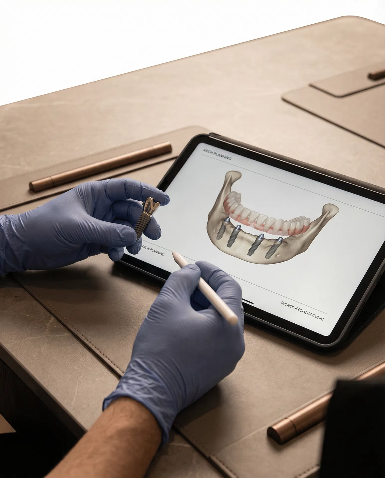 Dental implant planning detail showing a full-arch implant discussion