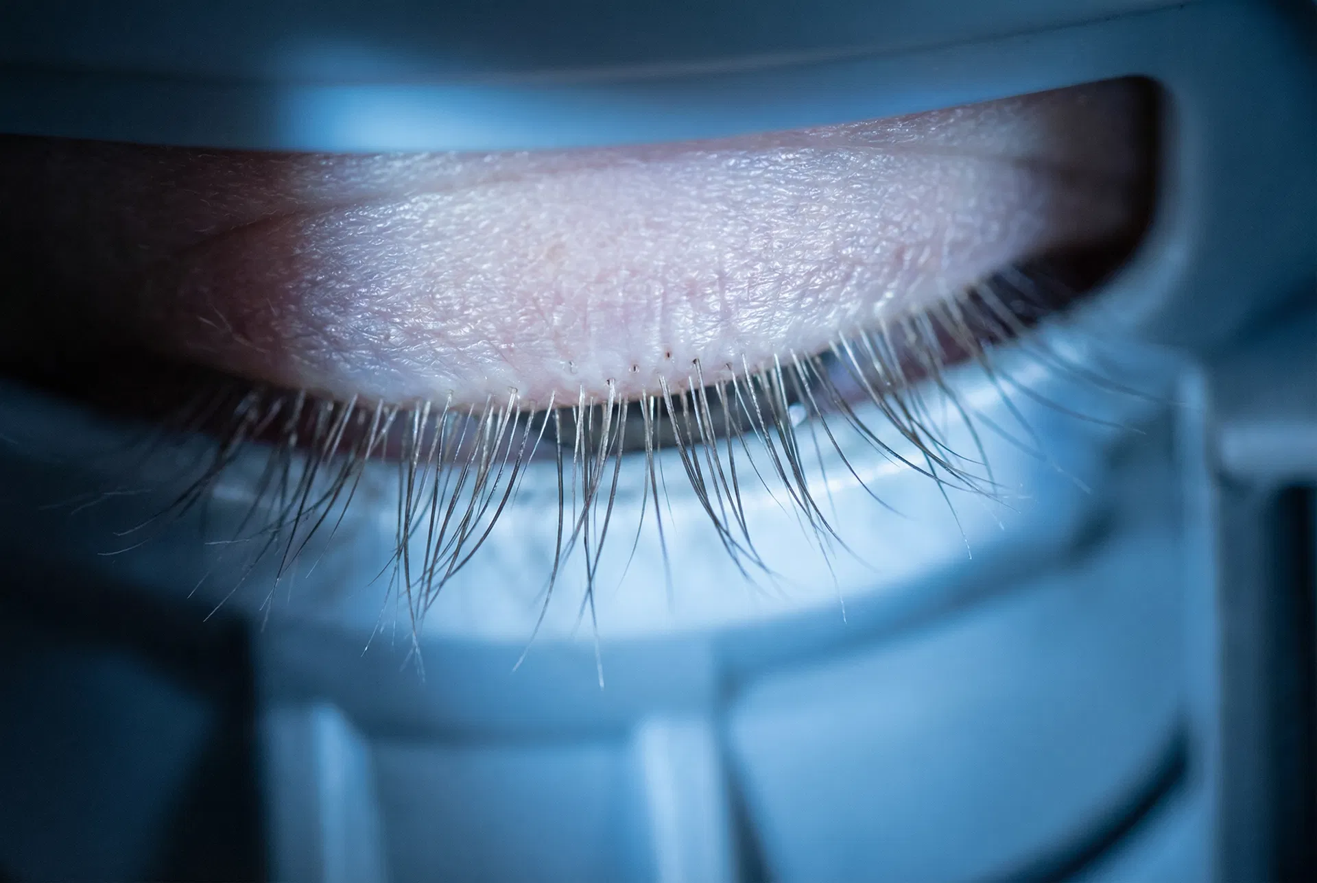 Demodex blepharitis treatment at ProVision Eye Associates Blue Bell PA