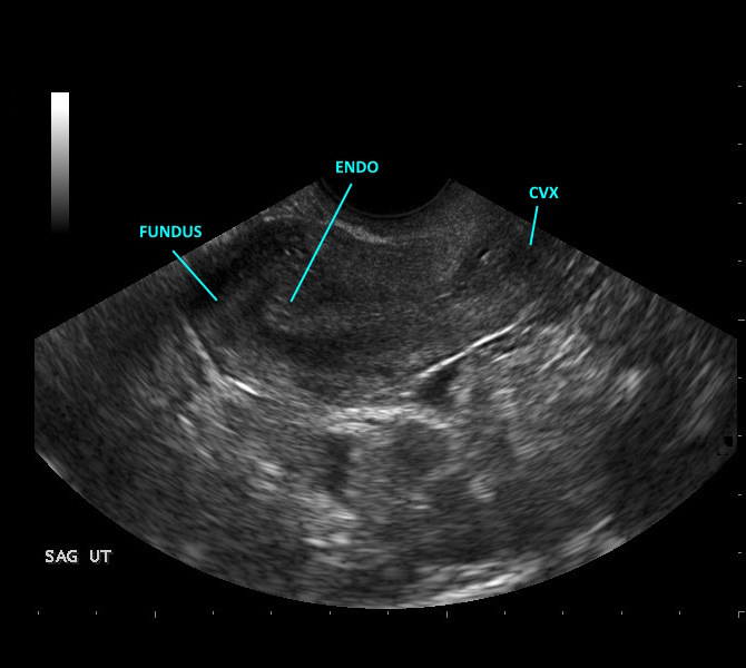 Uterus - Transvaginal