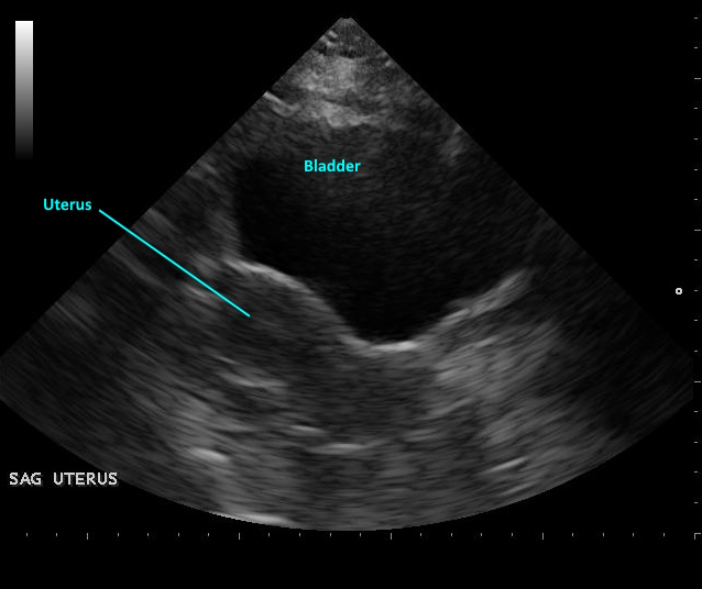Uterus - Transabdominal