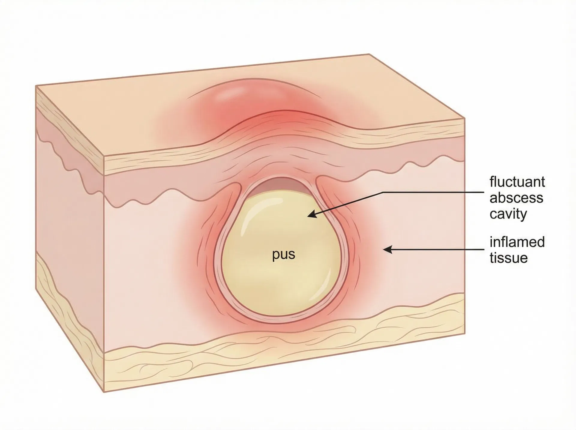 Medical illustration of a cutaneous abscess showing pus cavity beneath skin
