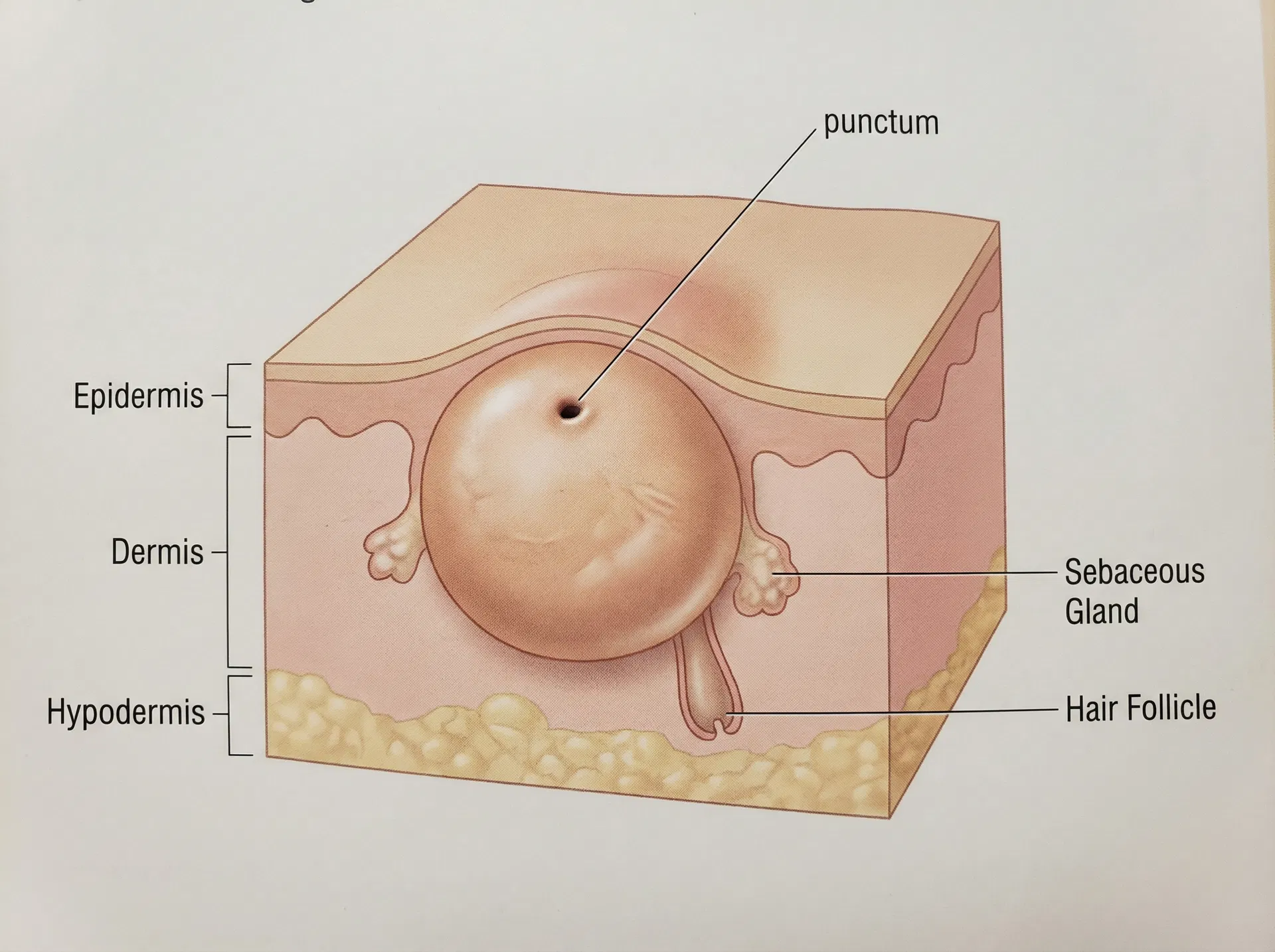 Medical illustration of an epidermoid cyst showing punctum and skin layers