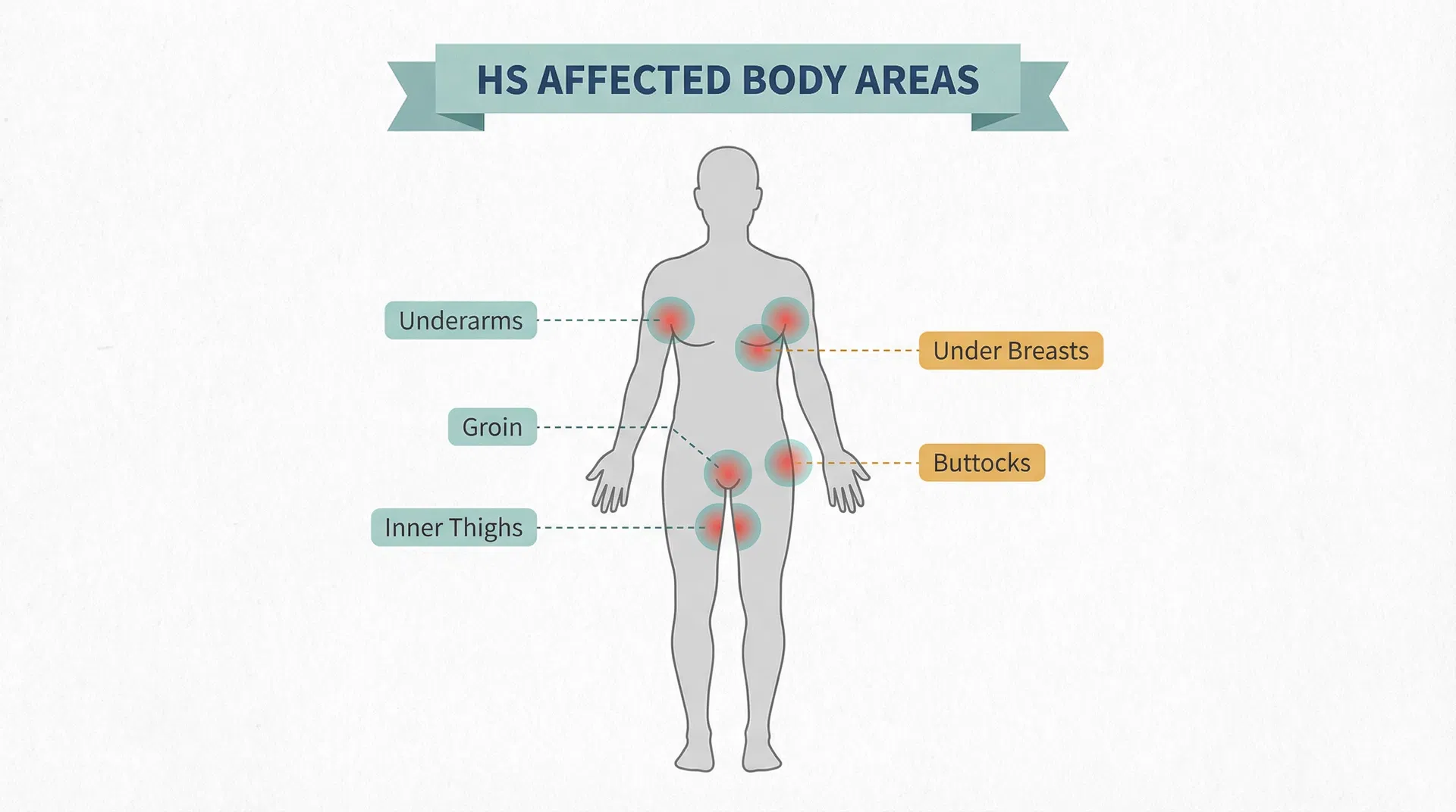 Body map showing HS affected areas: armpits, groin, inner thighs, buttocks, and under breasts