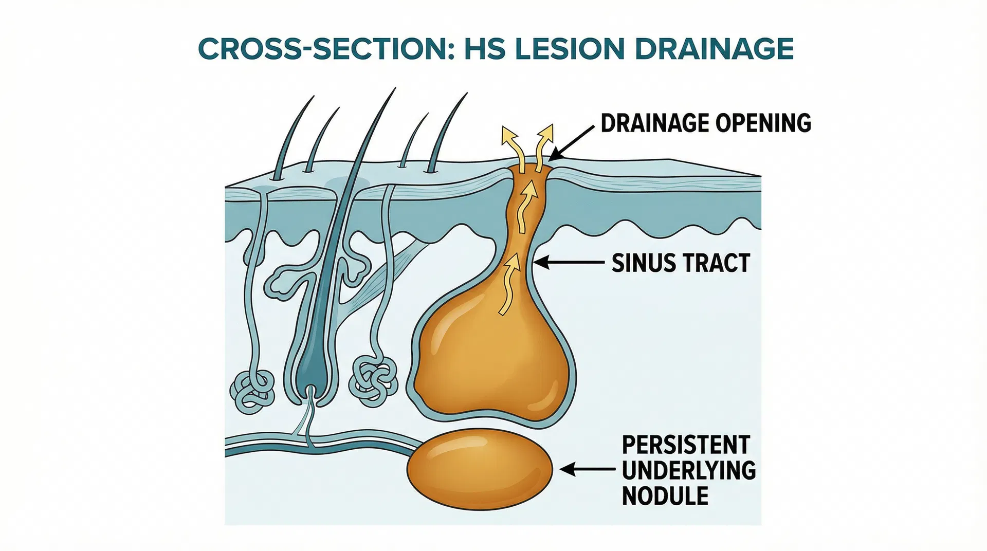 Cross-section illustration of an HS lesion showing drainage opening, sinus tract, and persistent underlying nodule