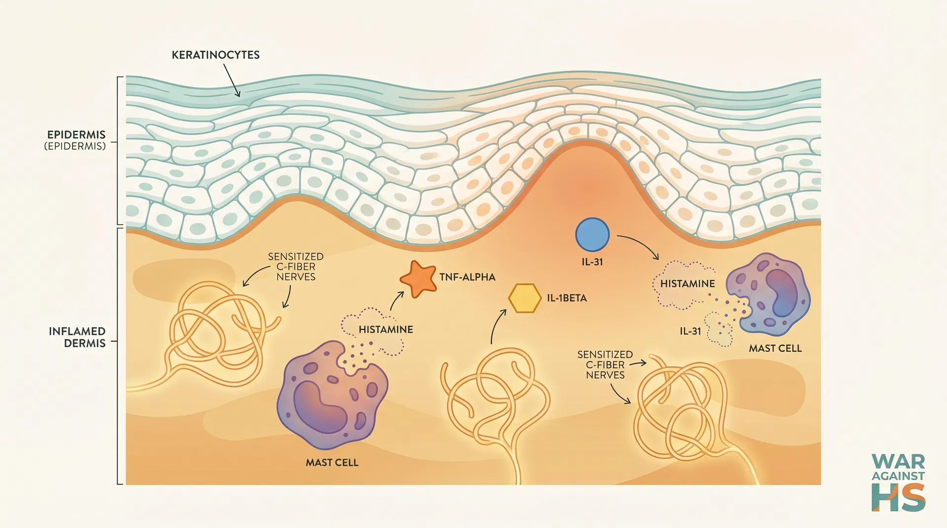 Diagram showing sensitized nerve endings, mast cells, and cytokines including IL-31 and TNF-alpha in HS-affected skin