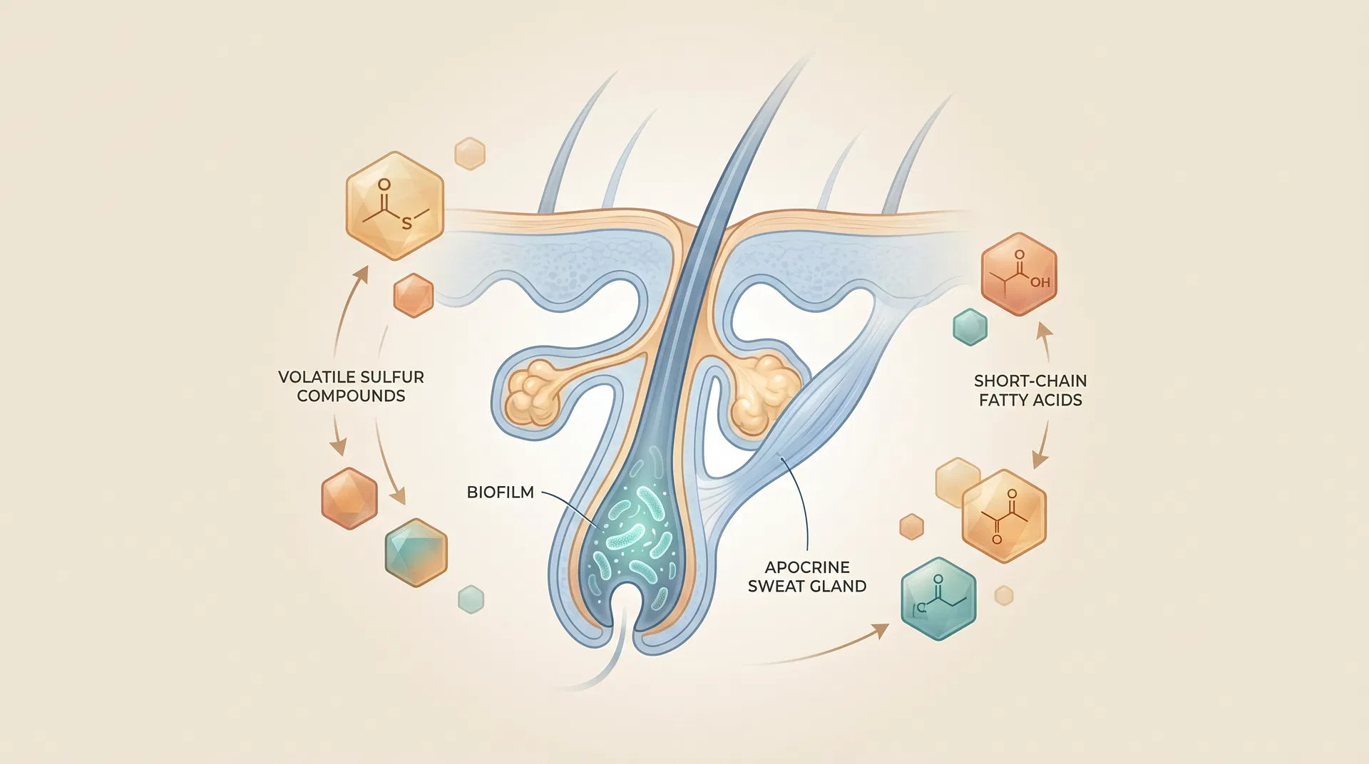 Anatomical cross-section of a hair follicle and apocrine sweat gland showing bacterial biofilm, anaerobic bacterial colonies, and volatile sulfur compound release in HS-affected skin