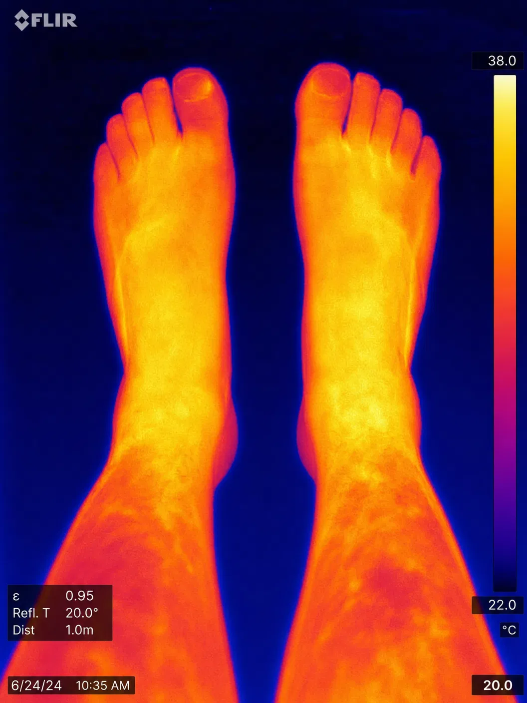 Thermography after comprehensive program — warmer colors indicate improved circulation