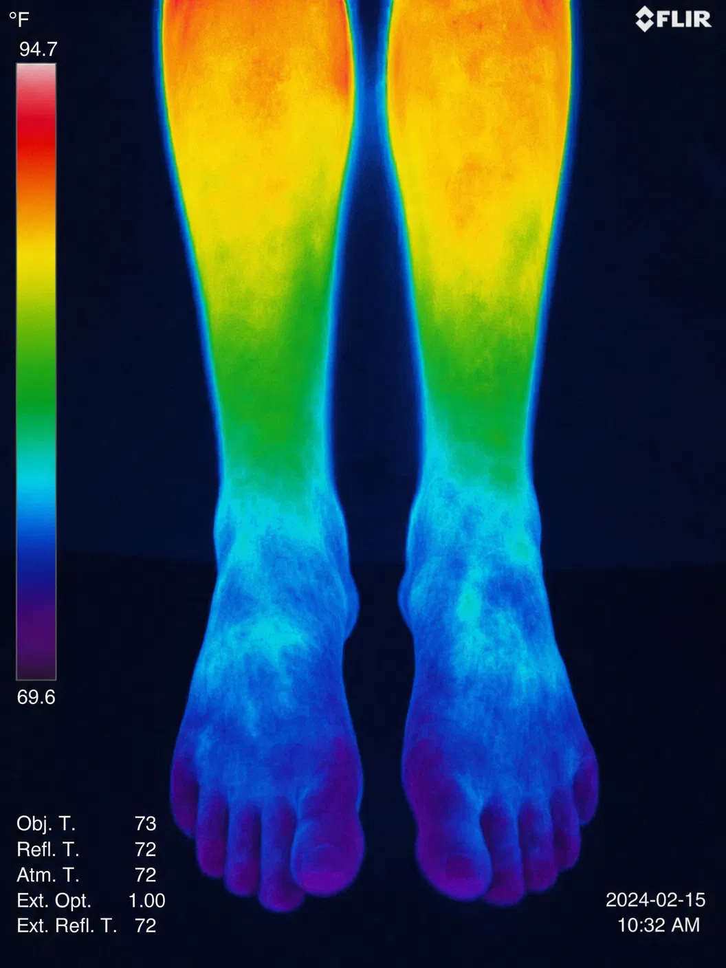 Thermography before treatment — cold areas indicate poor circulation