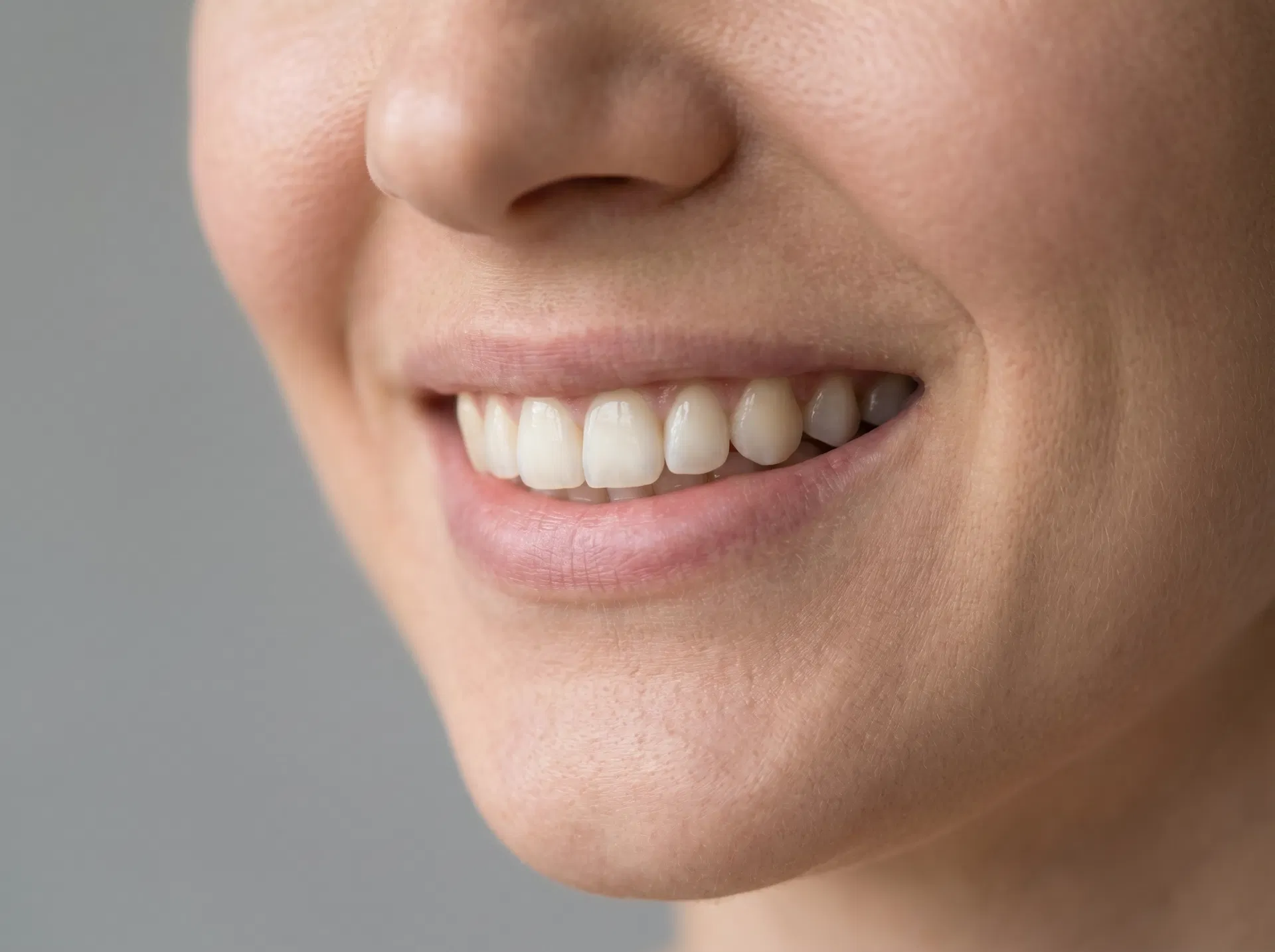 Shade refinement after filler smile example