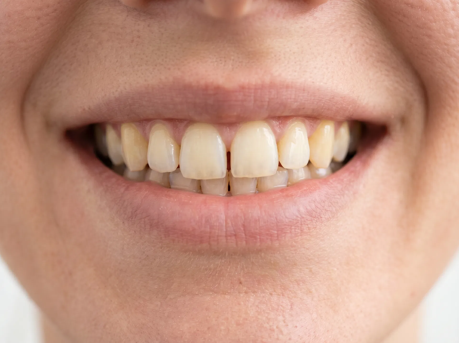 Shade refinement before filler smile example