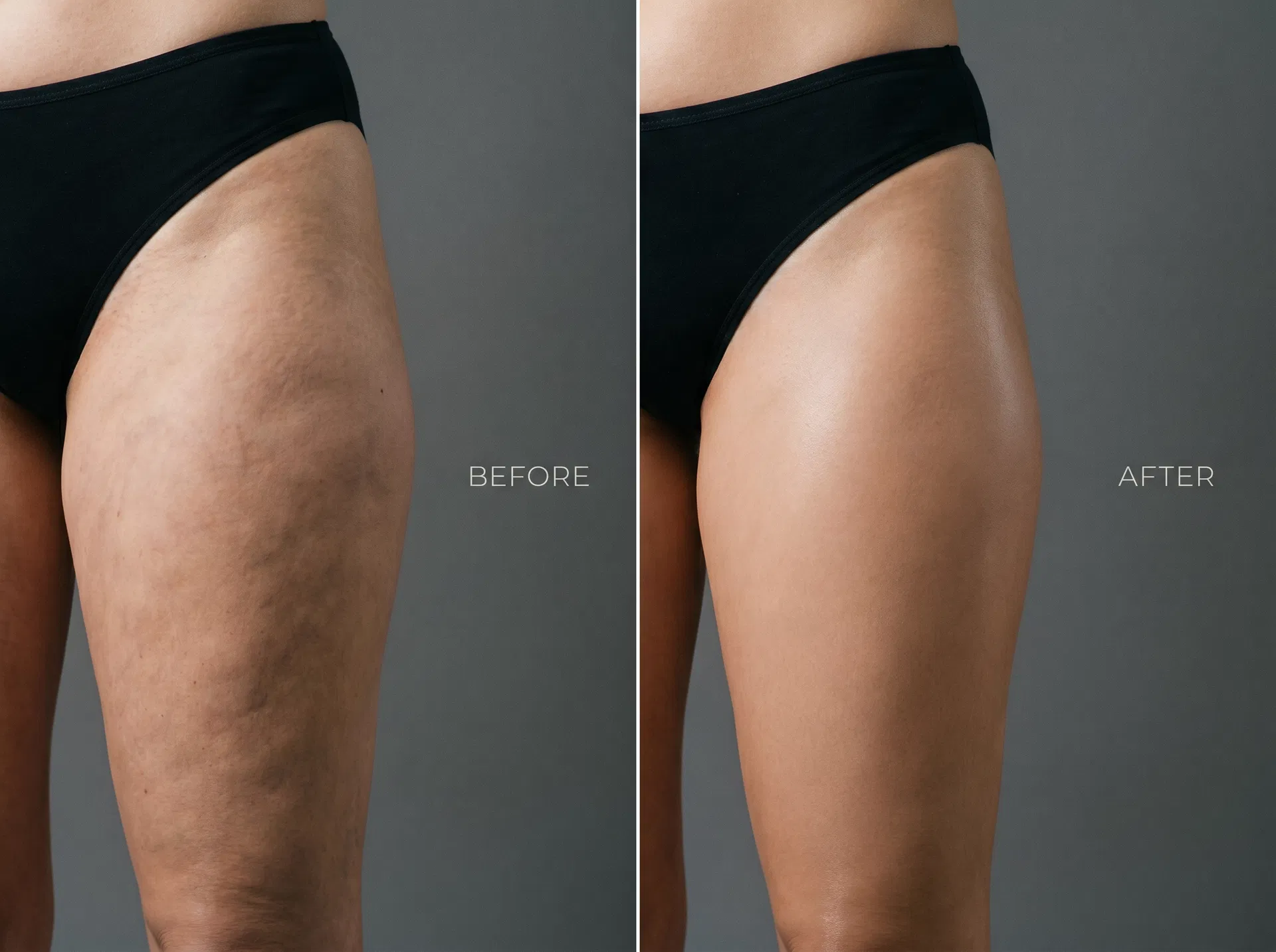 Front of Thighs — before and after results with the ZENN SculptRoll