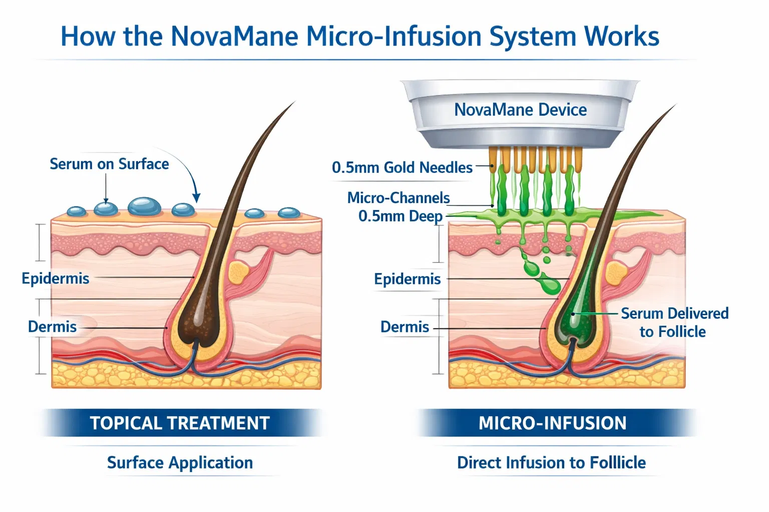 Micro-Infusion Mechanism Diagram