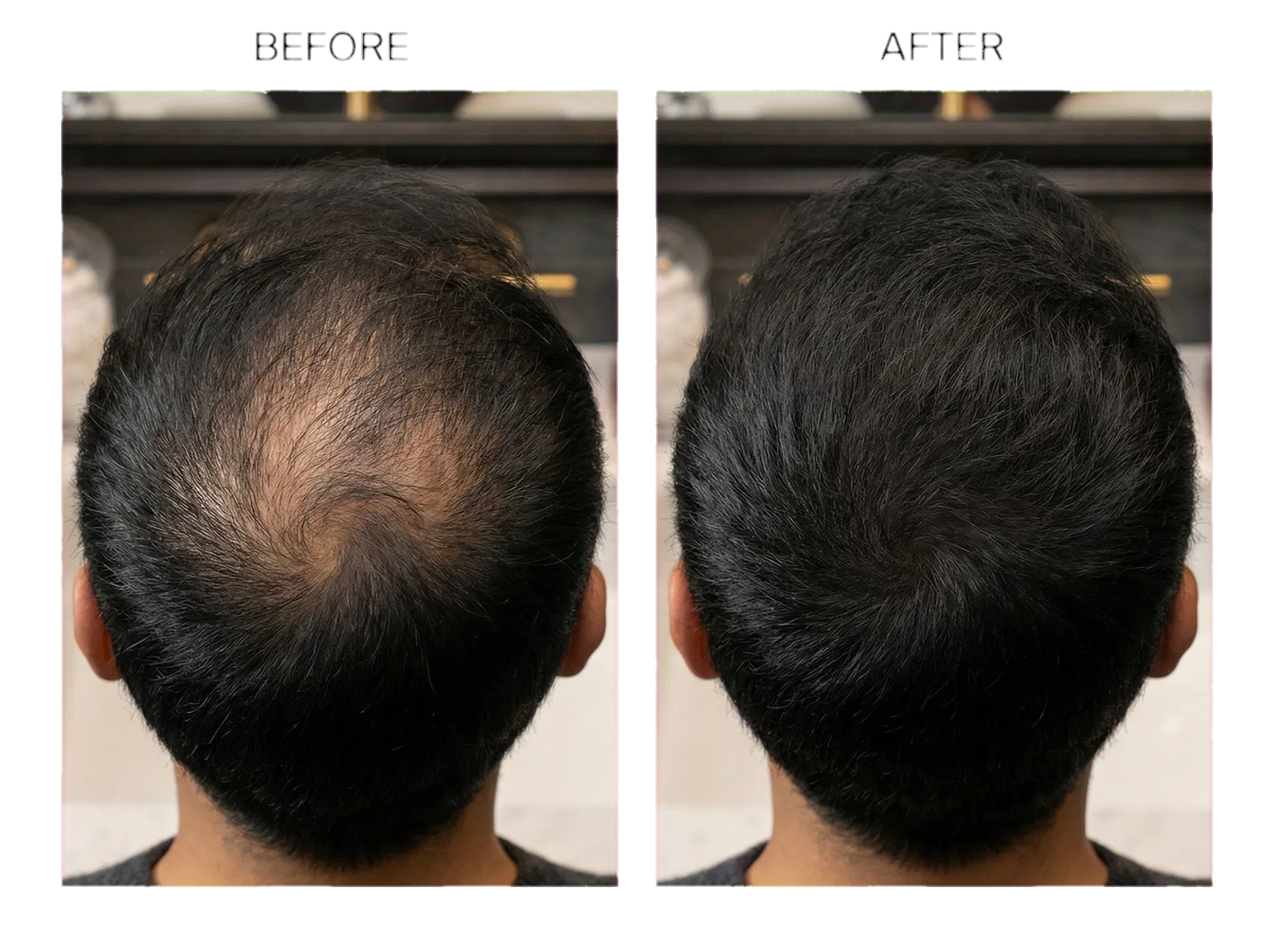 Same man shown before with a visibly thinner crown and after with fuller-looking hair coverage