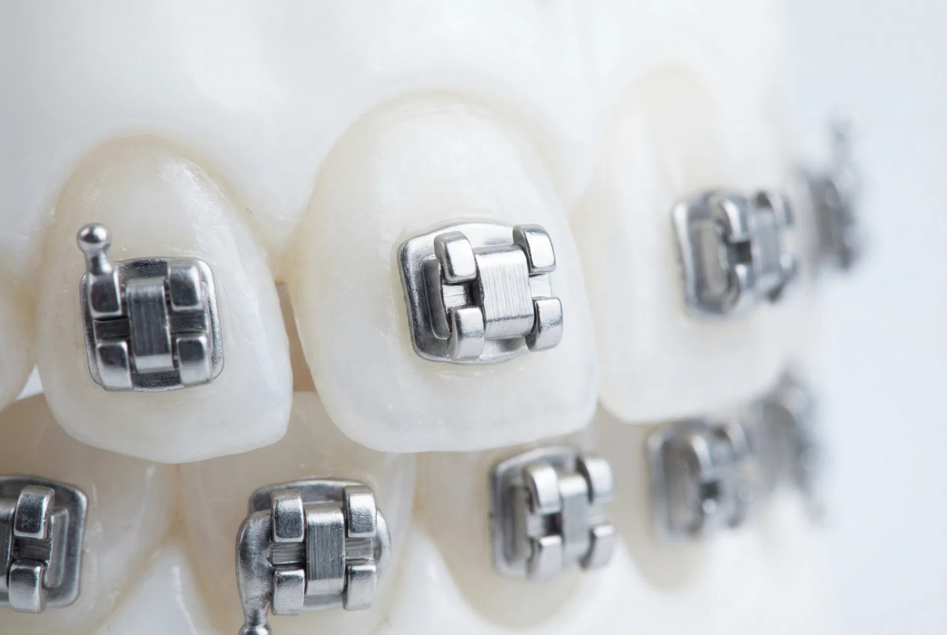 Damon™ Self-Ligating Braces