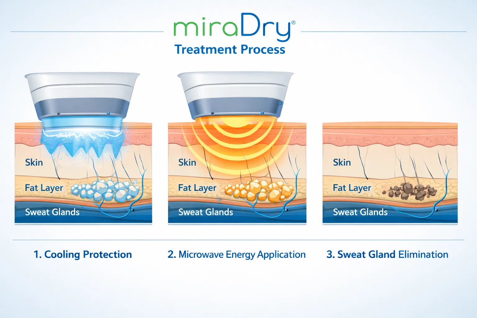 MiraDry Treatment Process