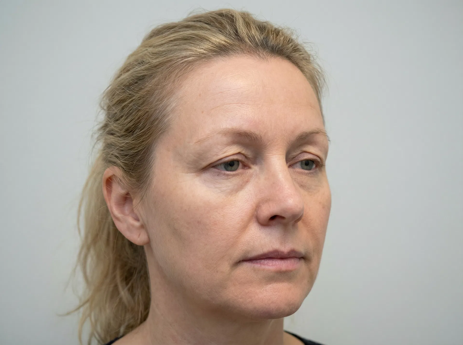 Typisk tilstand med hengende øvre øyelokk før behandling