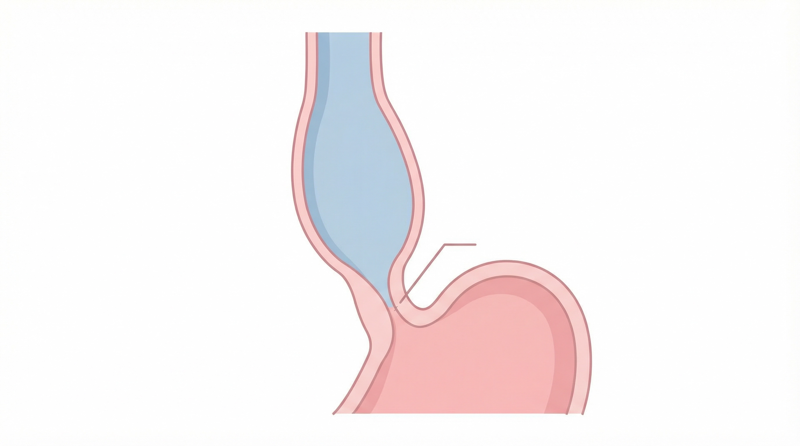 Medical illustration of Achalasia Cardia