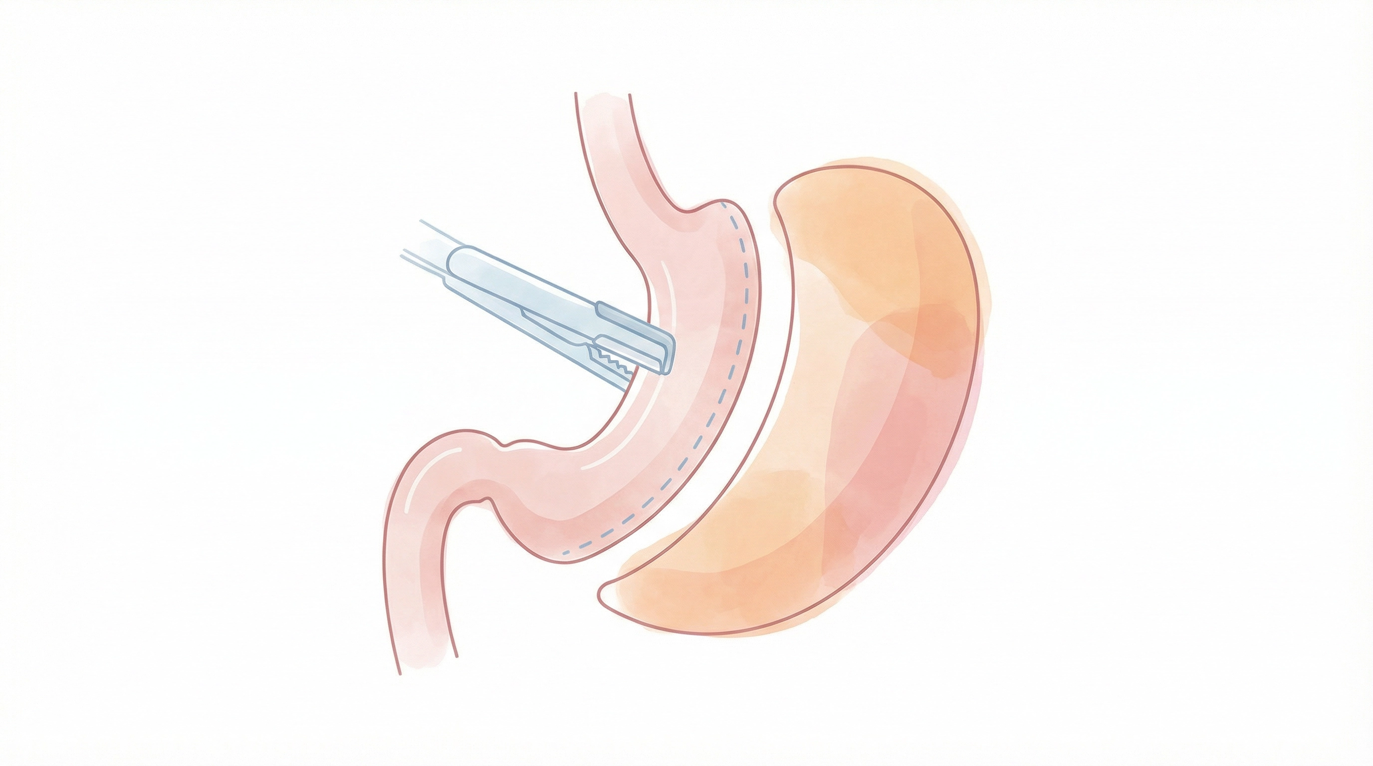 Medical illustration of Bariatric Surgery