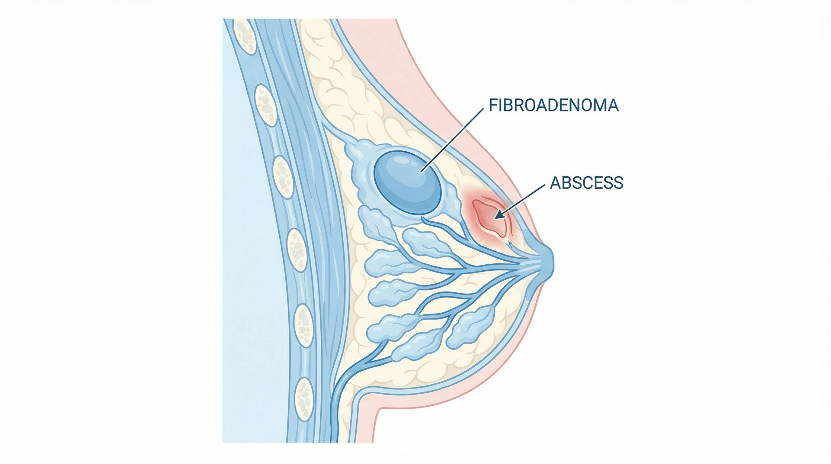Medical illustration of Breast Surgery