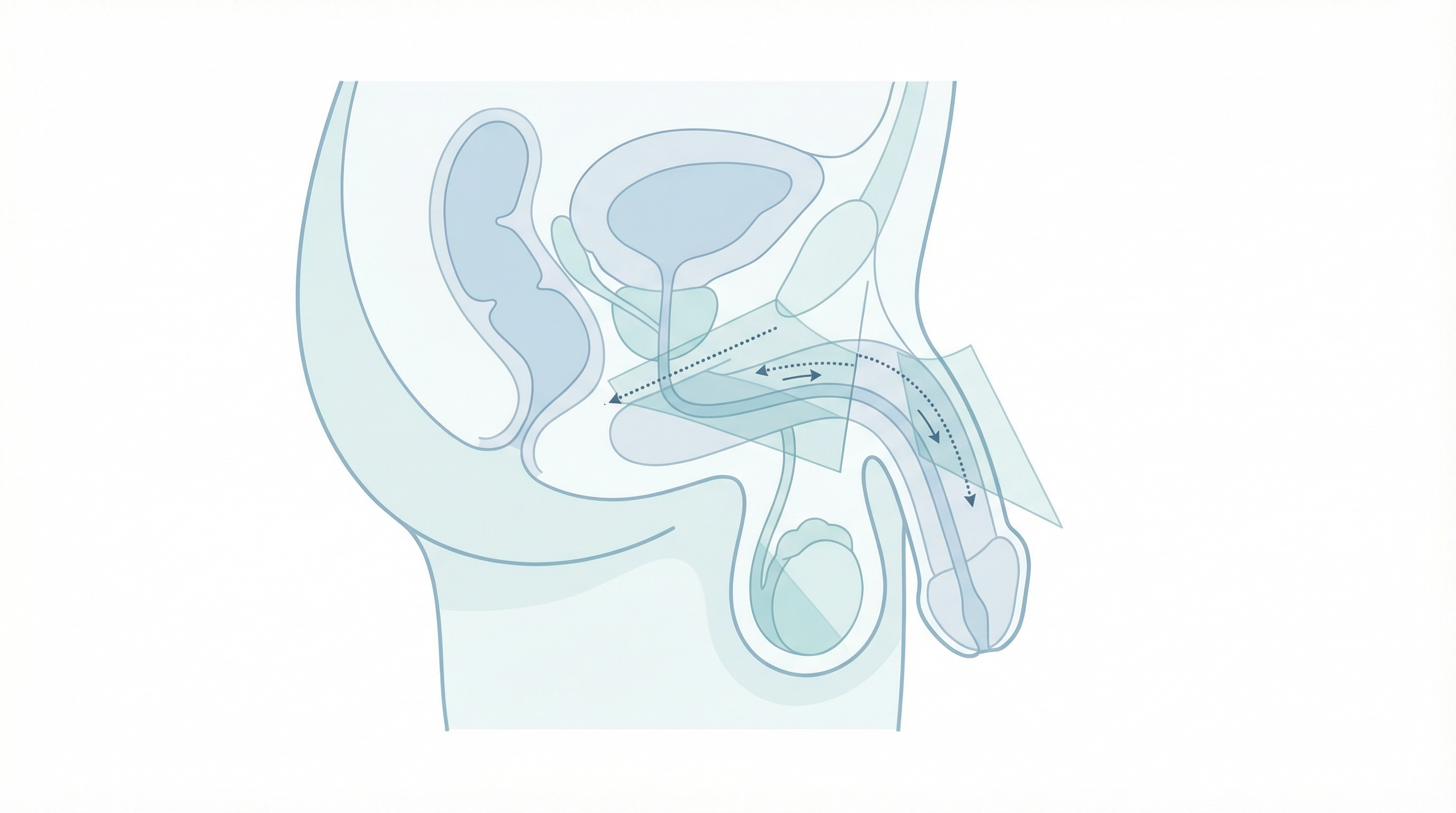 Medical illustration of Circumcision