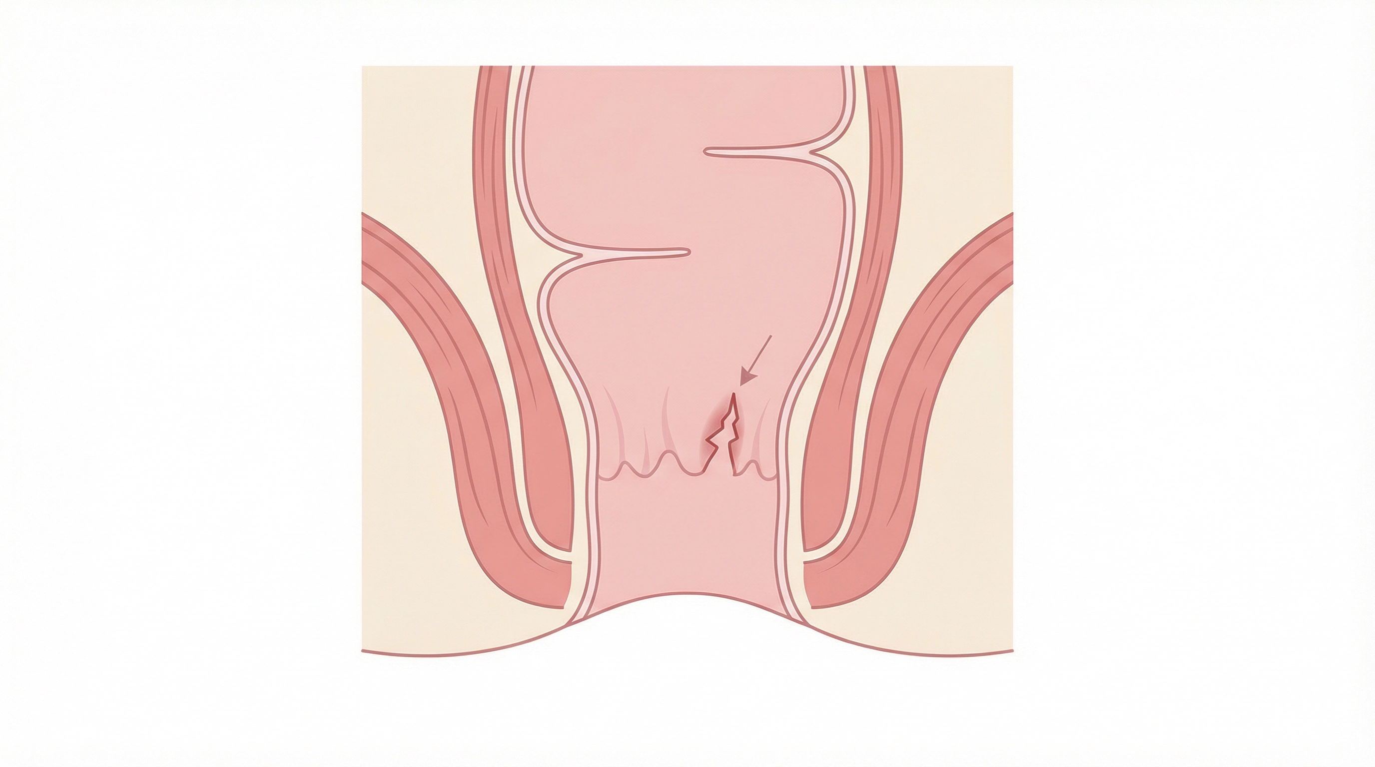 Medical illustration of Fissure Treatment