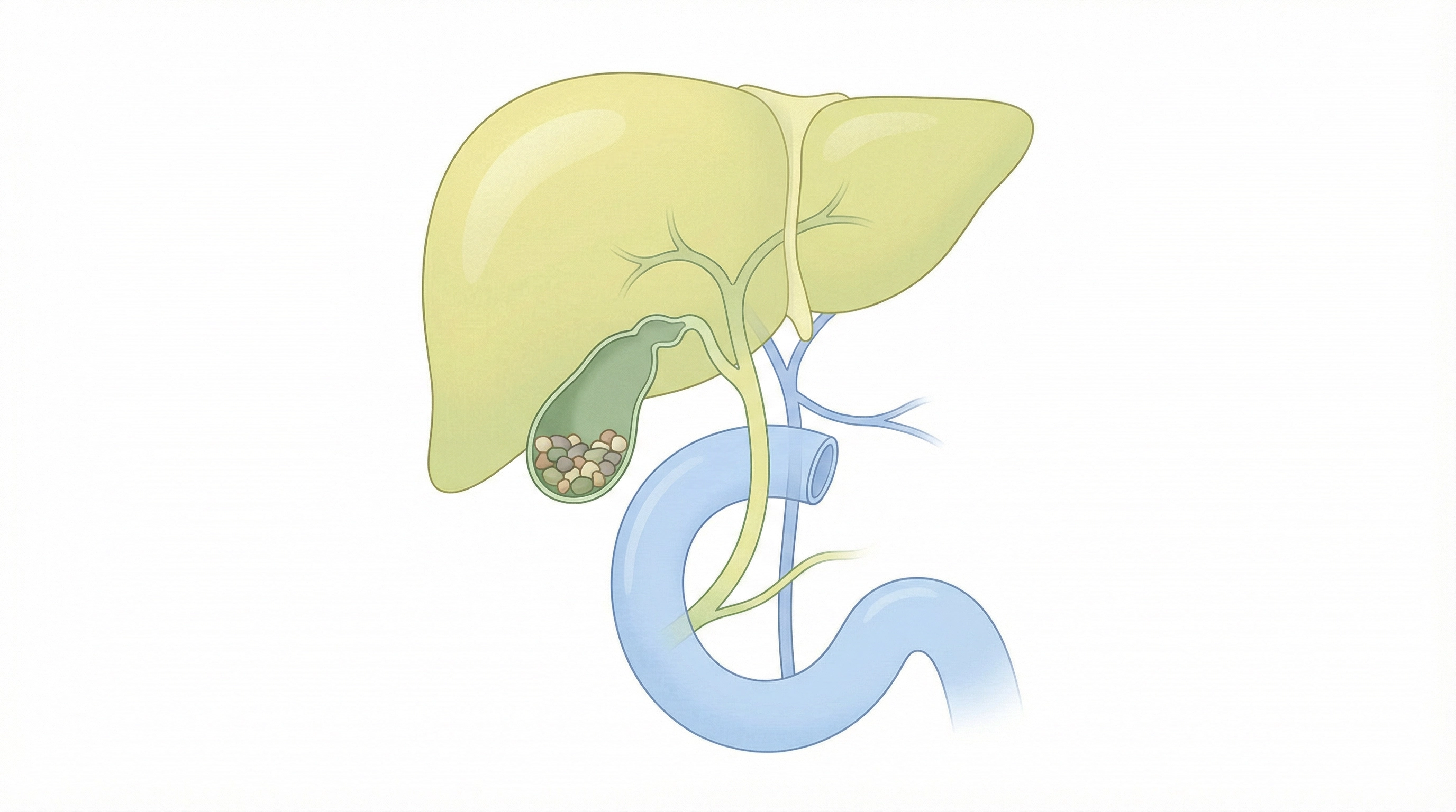 Medical illustration of Gallbladder Surgery