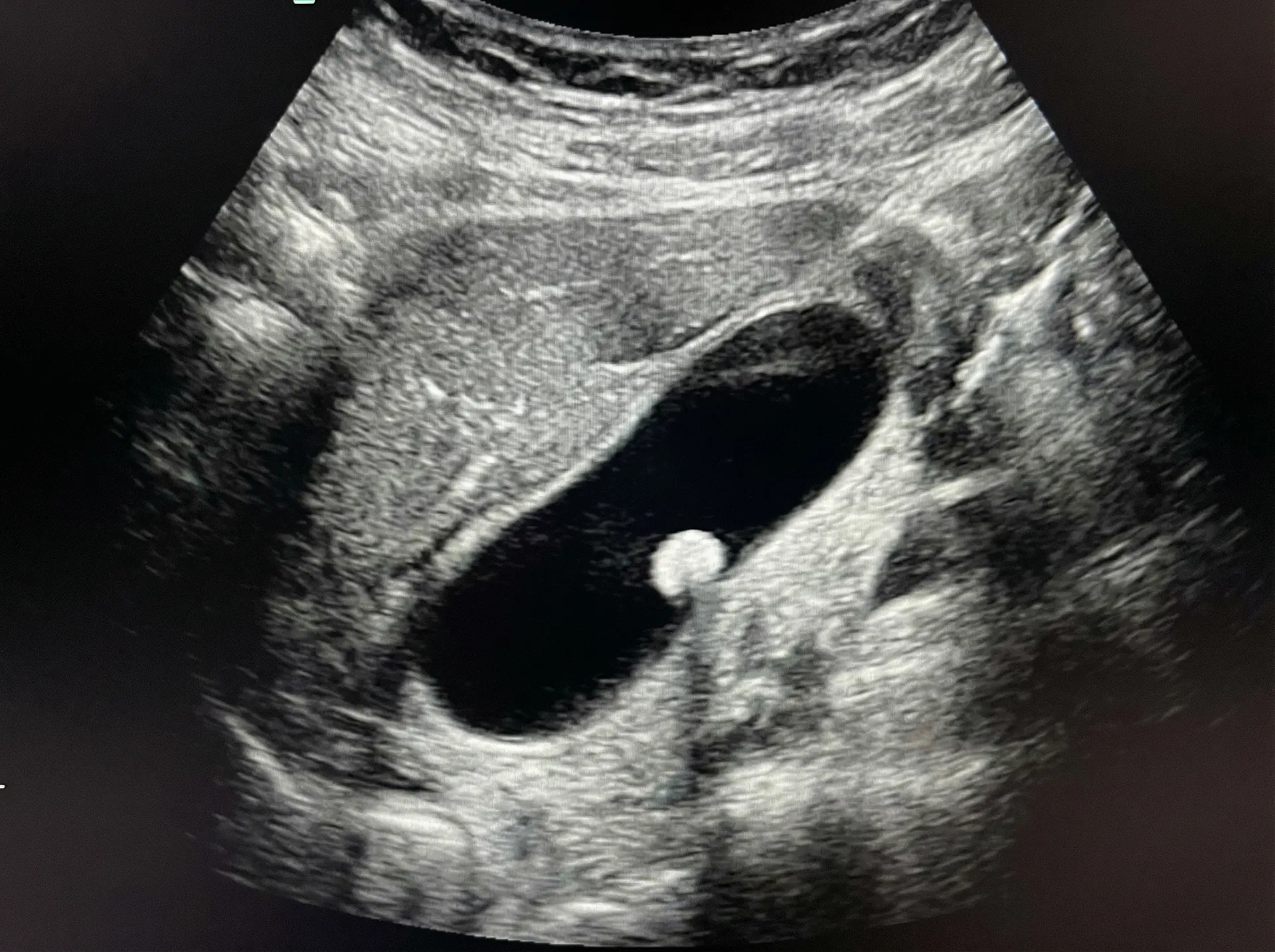 Gallbladder polyp on ultrasound scan — showing a small growth inside the gallbladder wall as seen during diagnostic imaging in Bangalore