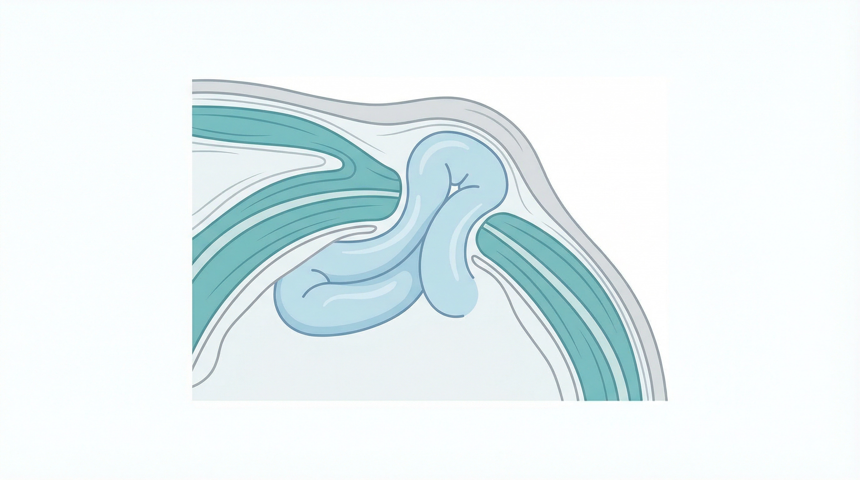Medical illustration of Hernia Surgery